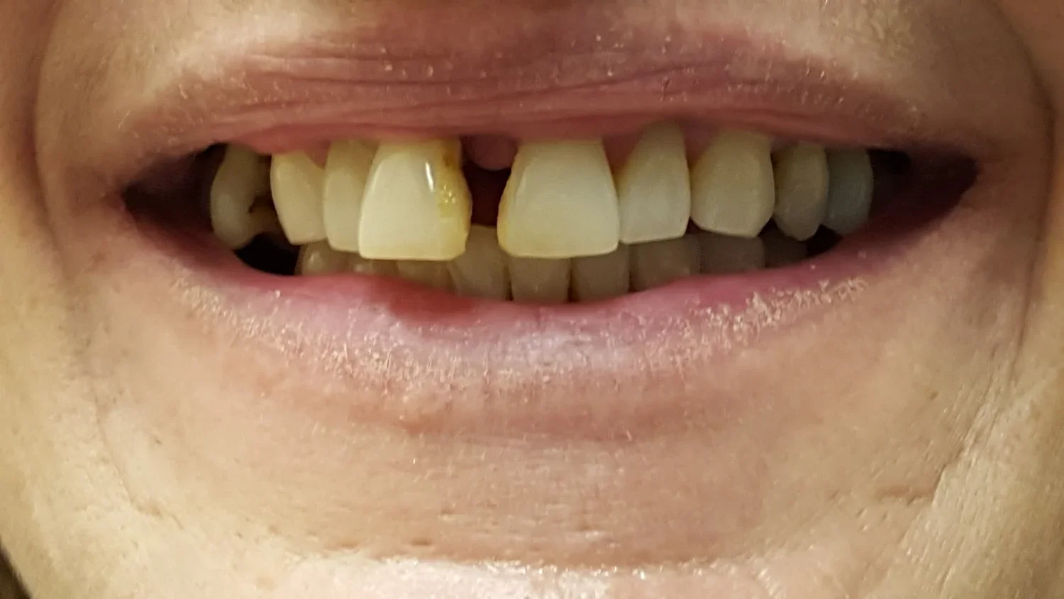 BEFORE - Dierdre (Copy) (Copy)