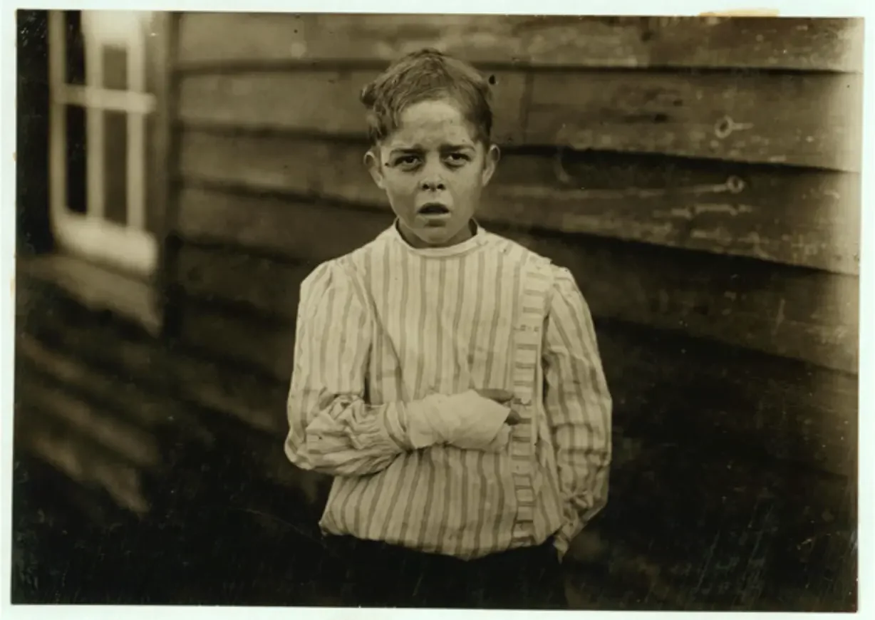 Accident to young mill worker. Giles Edmund Newsom (Photo October 23rd, 1912) while working in Sanders Spinning Mill, Bessemer City, N.C., August 21st, 1912