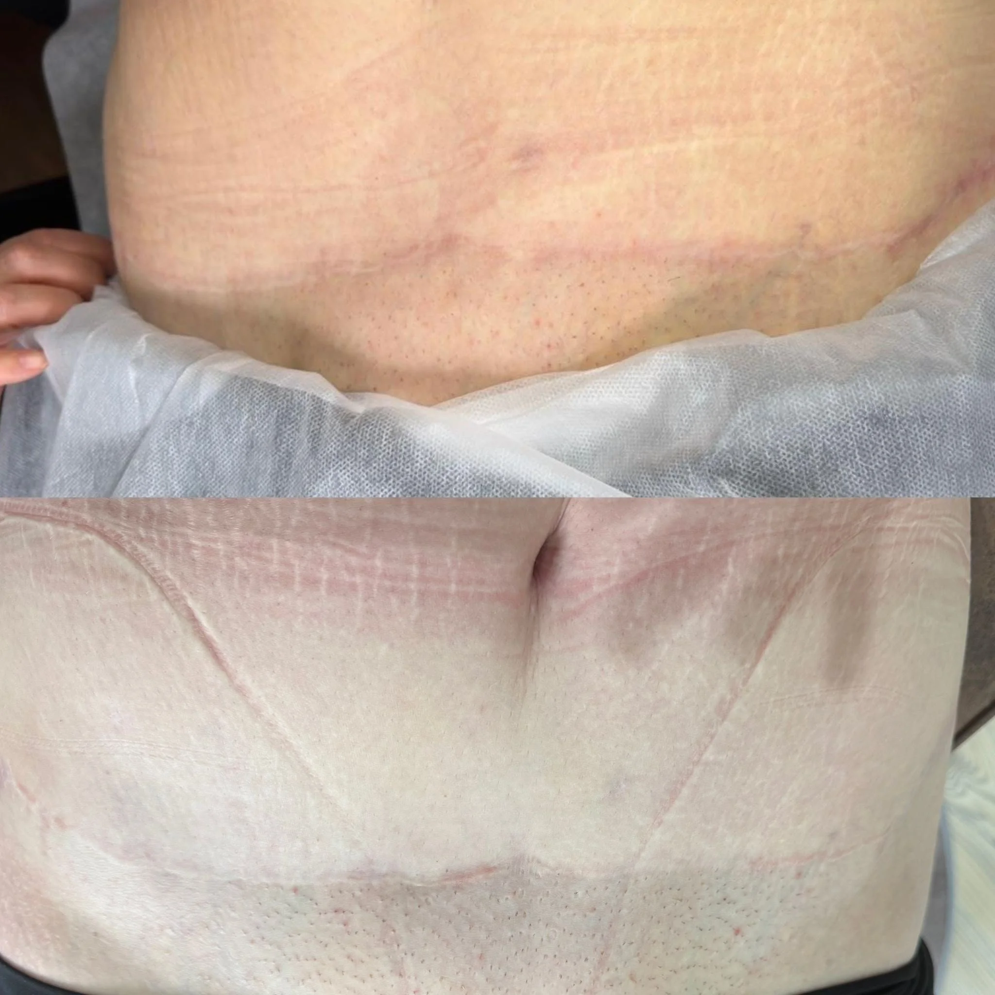 Nahaufnahme eines menschlichen Oberschenkels mit blasser Haut, sichtbar sind vereinzelte kleine rote Punkte und leichte Hautfalten.