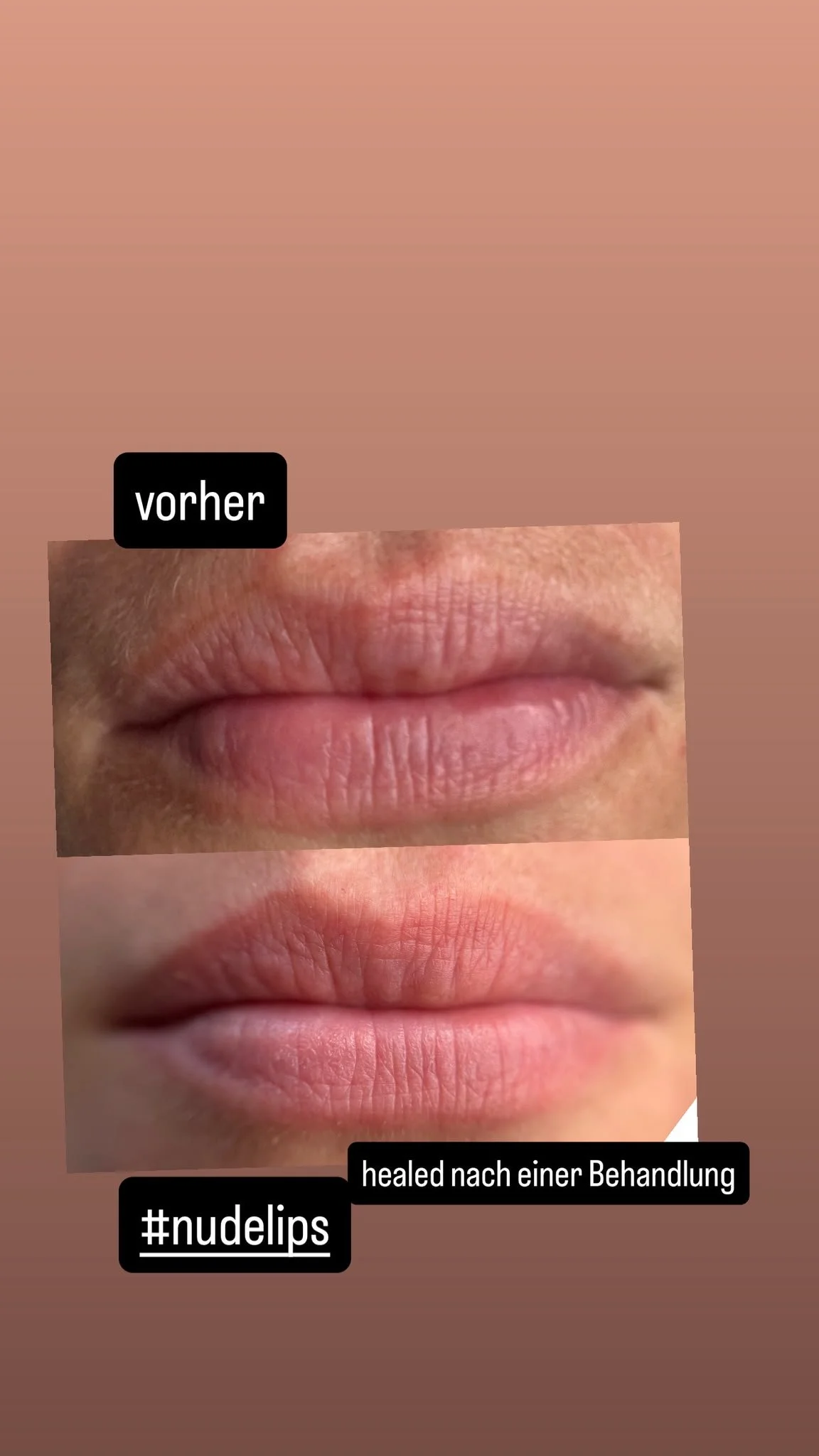 Vorher- und nachher-Bilder von Heilung an den Lippen, mit Texten 'vorher' and 'healed nach einer Behandlung' und Hashtag '#nudelips'.