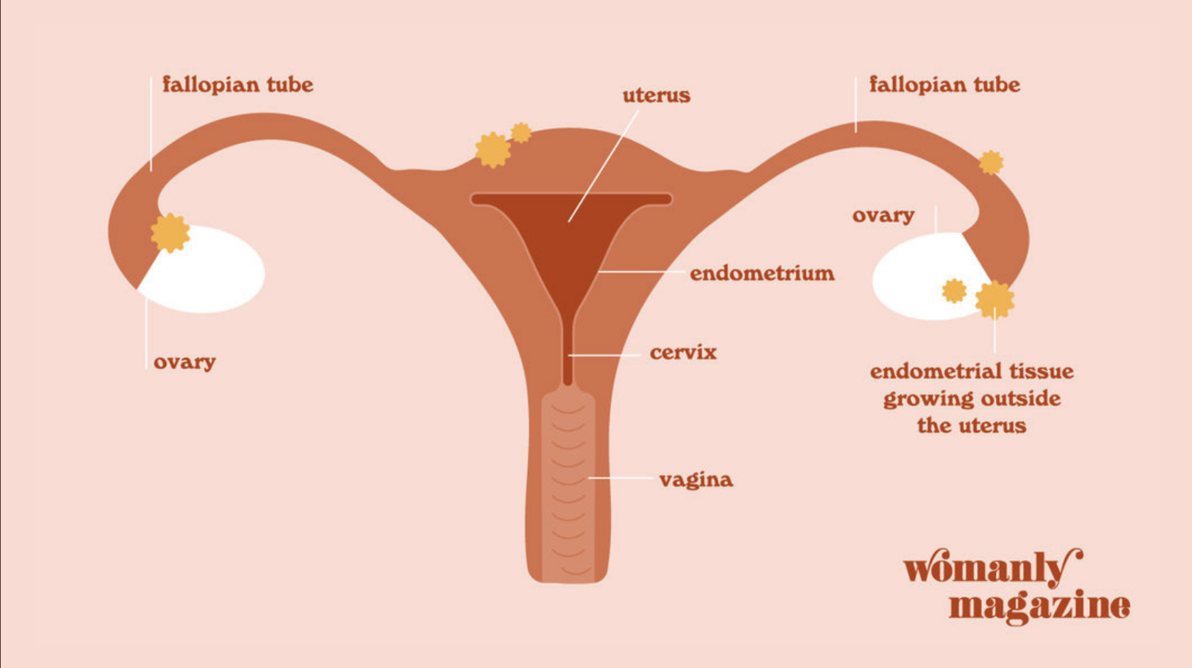 Endometriosis