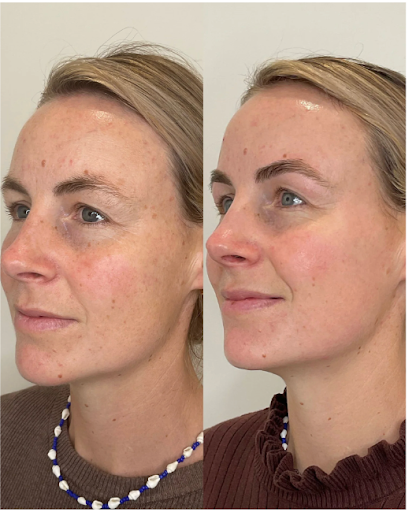 MOXI Laser Skin Treatment Whakatane: Gentle, Effective, and Perfect for Sun Damage