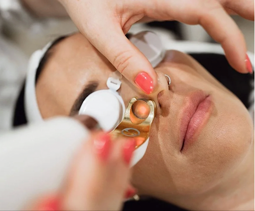 ClearV Vascular Laser Treatment Bay of Plenty: Safe Solutions for Redness &amp; Veins