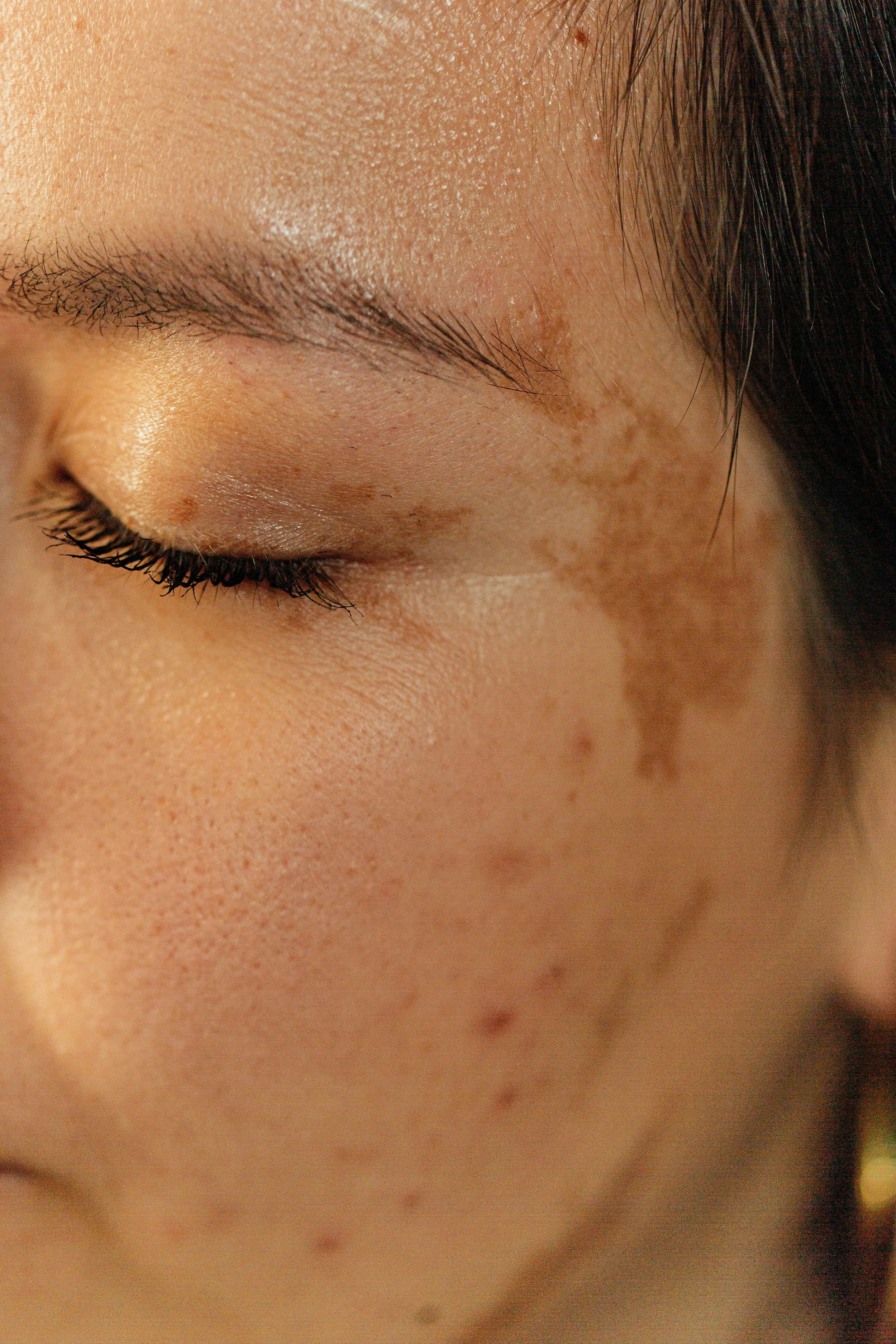 Pigmentation