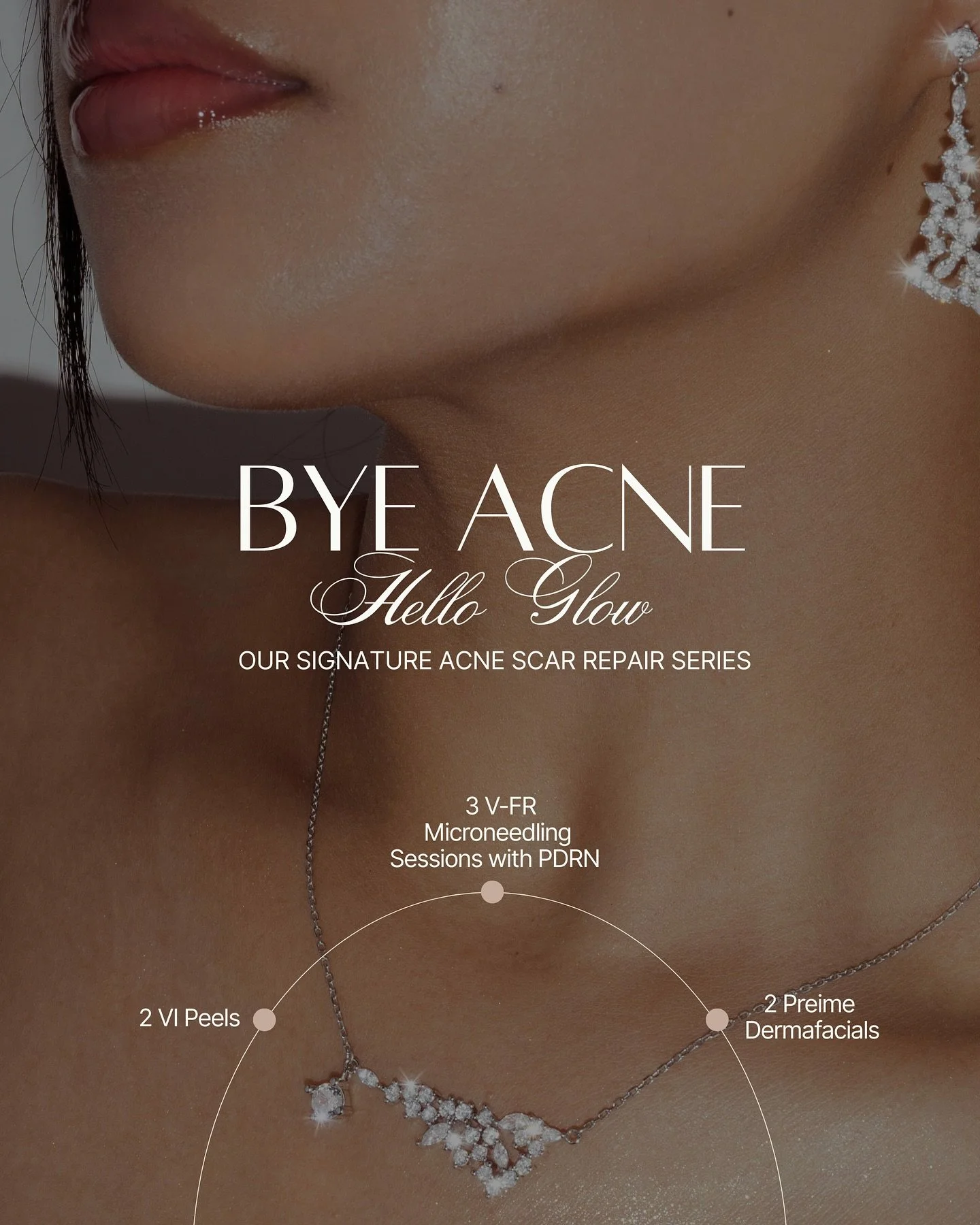 Our Signature Acne Scar Repair Series is designed to target acne scars, textured skin, active breakouts, PIH, large pores &amp; dullness, leaving you with smooth, radiant, filter-free skin✨🙌🏽

This full face + neck series includes:

- V-FR Micronee