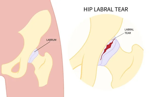 hip labral tear anatomy