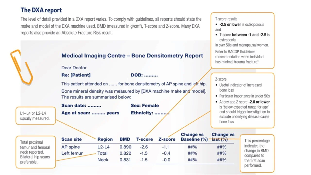 An example of an osteoporosis scan with T-scores