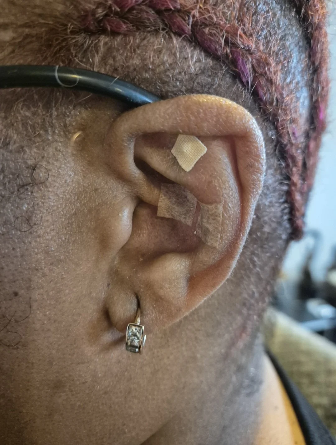 Ear Seeding Explained: How It Works and Why So Many People Are Talking About It