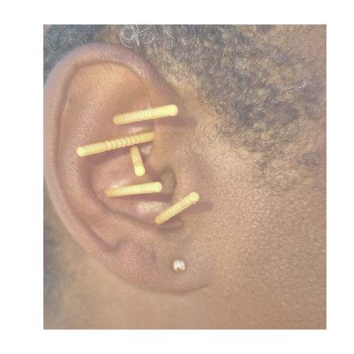 Close-up of a person's ear with the NADA 5-point protocol using orange acupuncture needles.