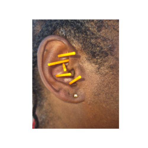 A close-up of a person's ear with multiple yellow and orange q-tips inserted into the ear canal.