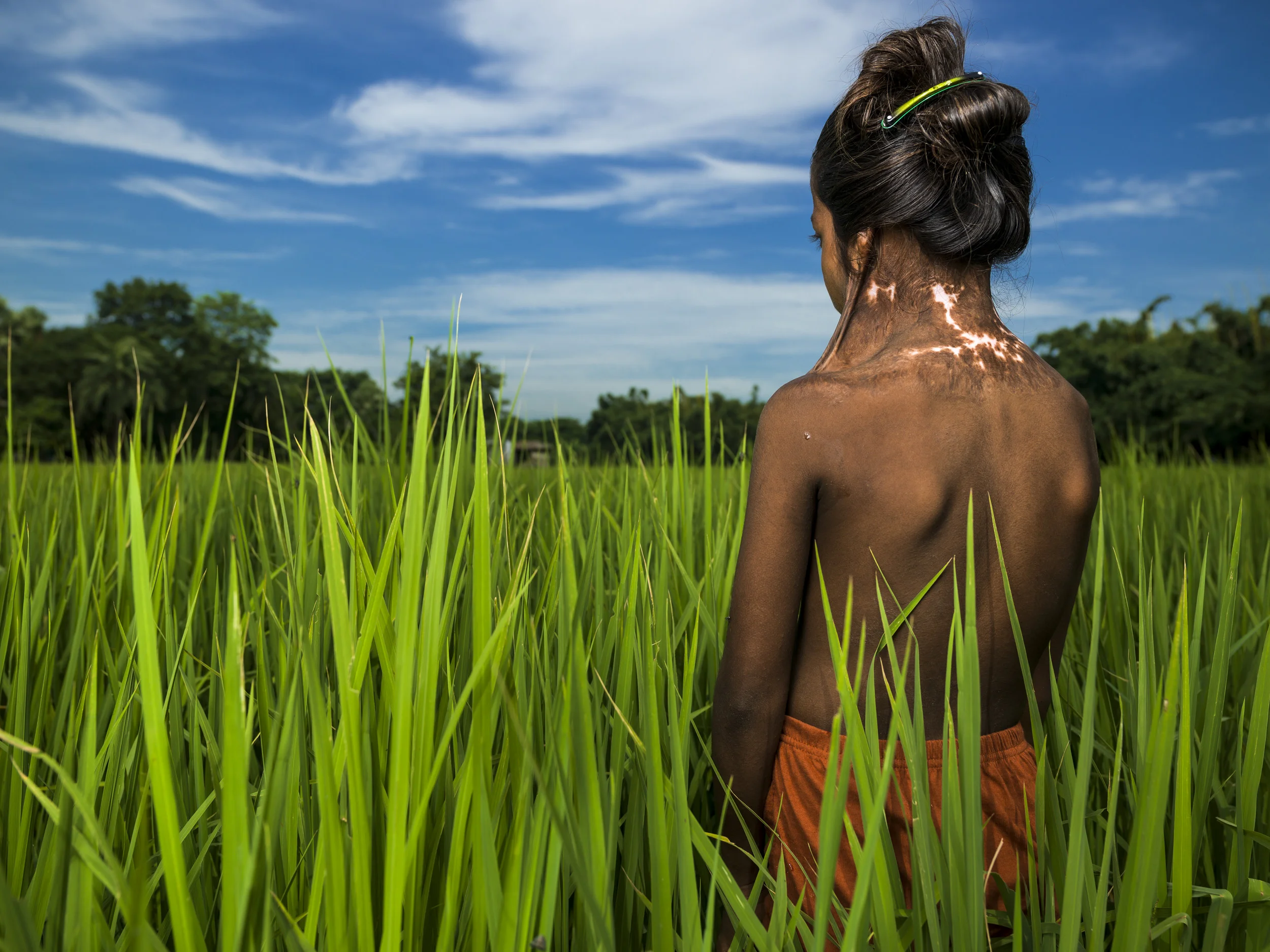 MUZZAFARPUR, INDIA, 5 SEPTEMBER 2014: Ragini Kumari, 10, was badly burnt by a Kerosene fire when she was 2 years old, she is one of over 6 million people burnt in India every year. Ragini has suffered constrictions of her neck and shoulders and live