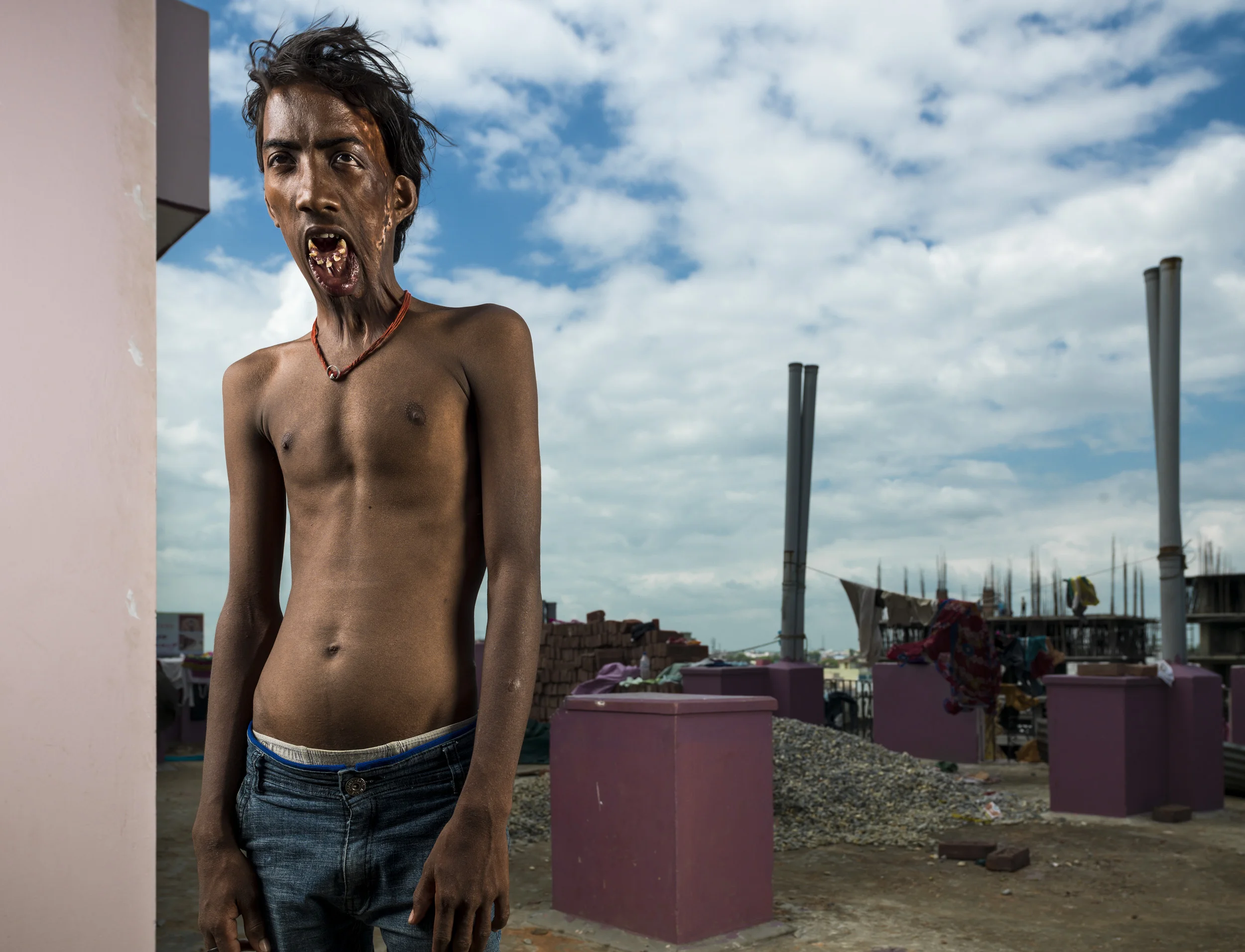 VARANASI, INDIA, 5 SEPTEMBER 2014: Burn victims seen at a burns camp held by renowned plastic surgeon to the poor, Dr Subodh Singh, for some of the over 6 million people burnt in India every year. Most victims are deeply impoverished and like millio