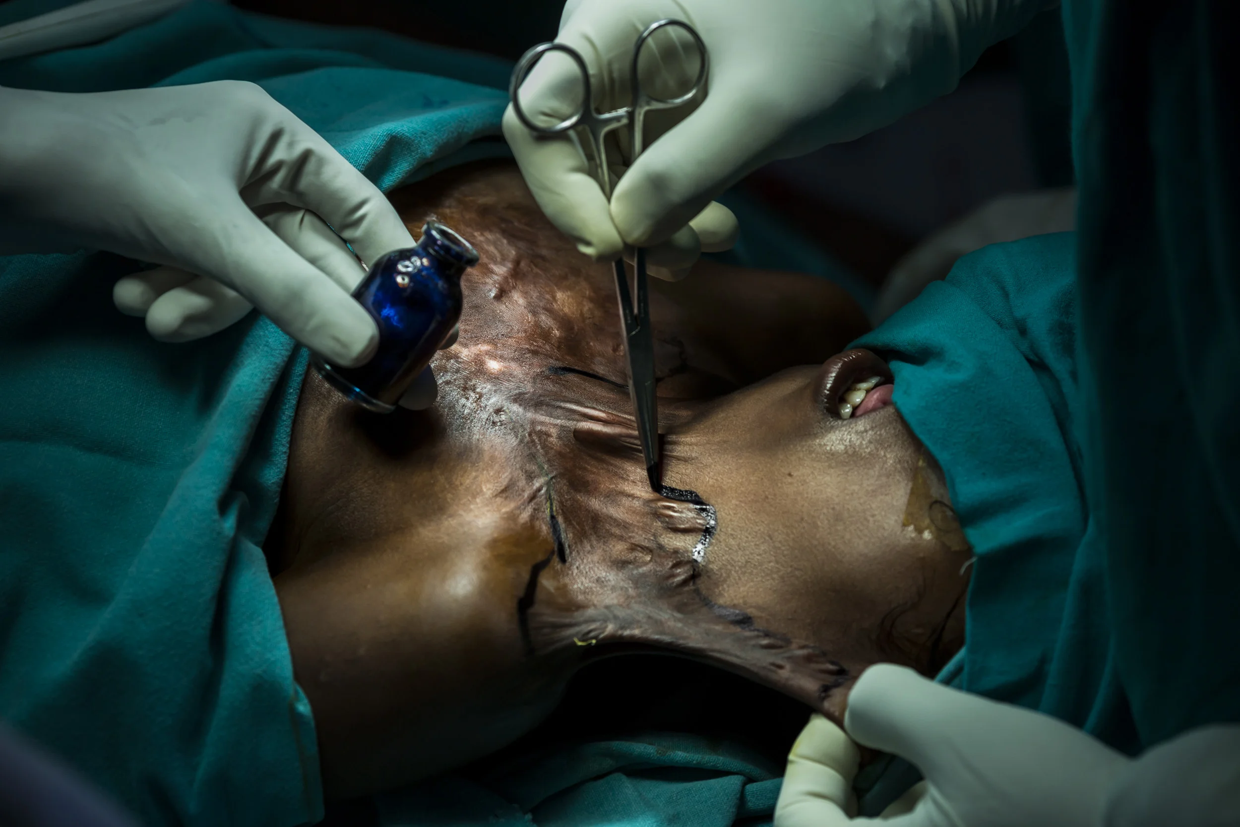VARANASI, INDIA, 8 SEPTEMBER 2014: Renowned plastic surgeon to the poor, Dr Subodh Singh operates on burn victim Ragini Kumari, 10, who was badly burnt by a Kerosene fire when she was 2 years old, she is one of over 6 million people burnt in India e
