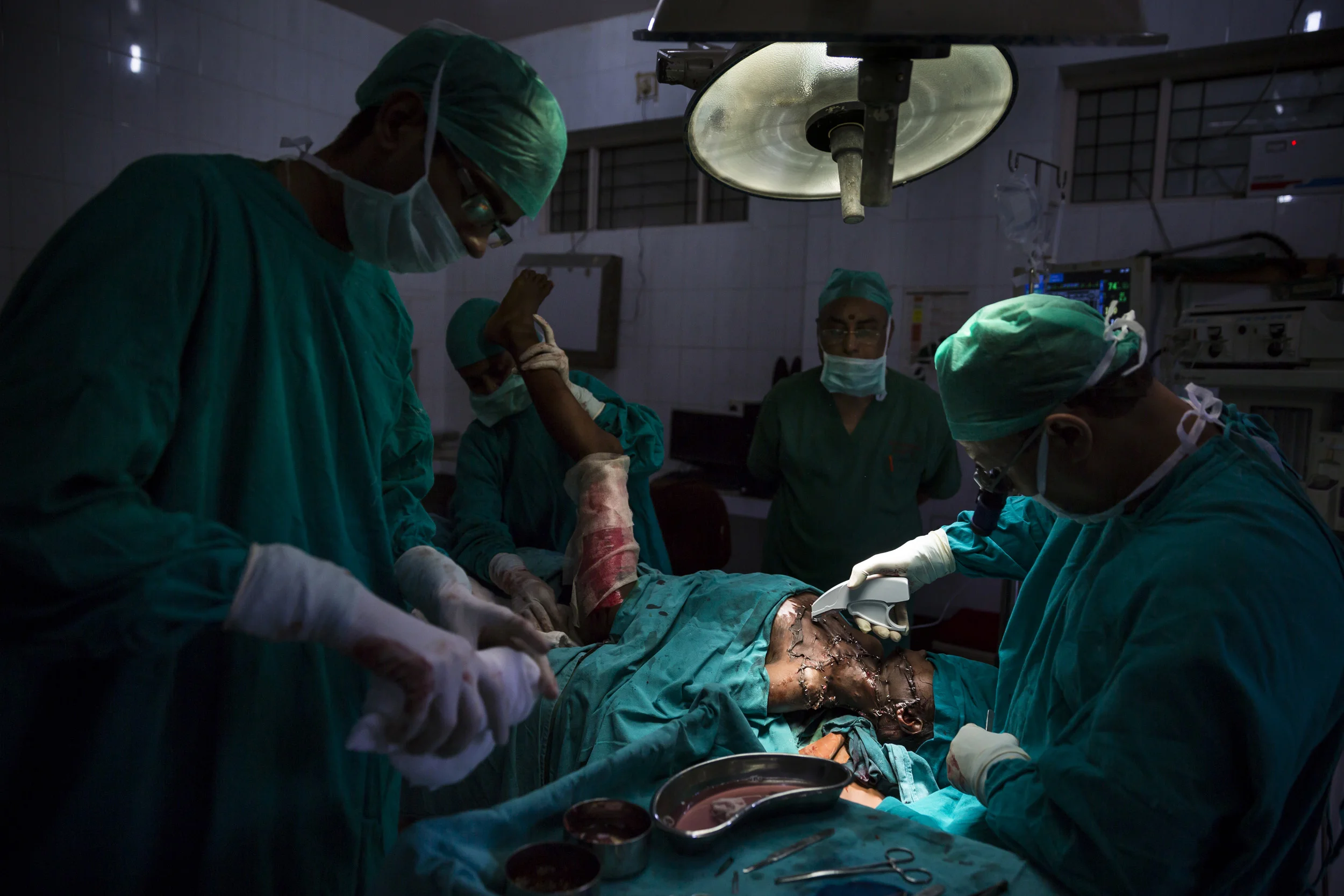VARANASI, INDIA, 8 SEPTEMBER 2014: Renowned plastic surgeon to the poor, Dr Subodh Singh operates on burn victim Ragini Kumari, 10, who was badly burnt by a Kerosene fire when she was 2 years old, she is one of over 6 million people burnt in India e