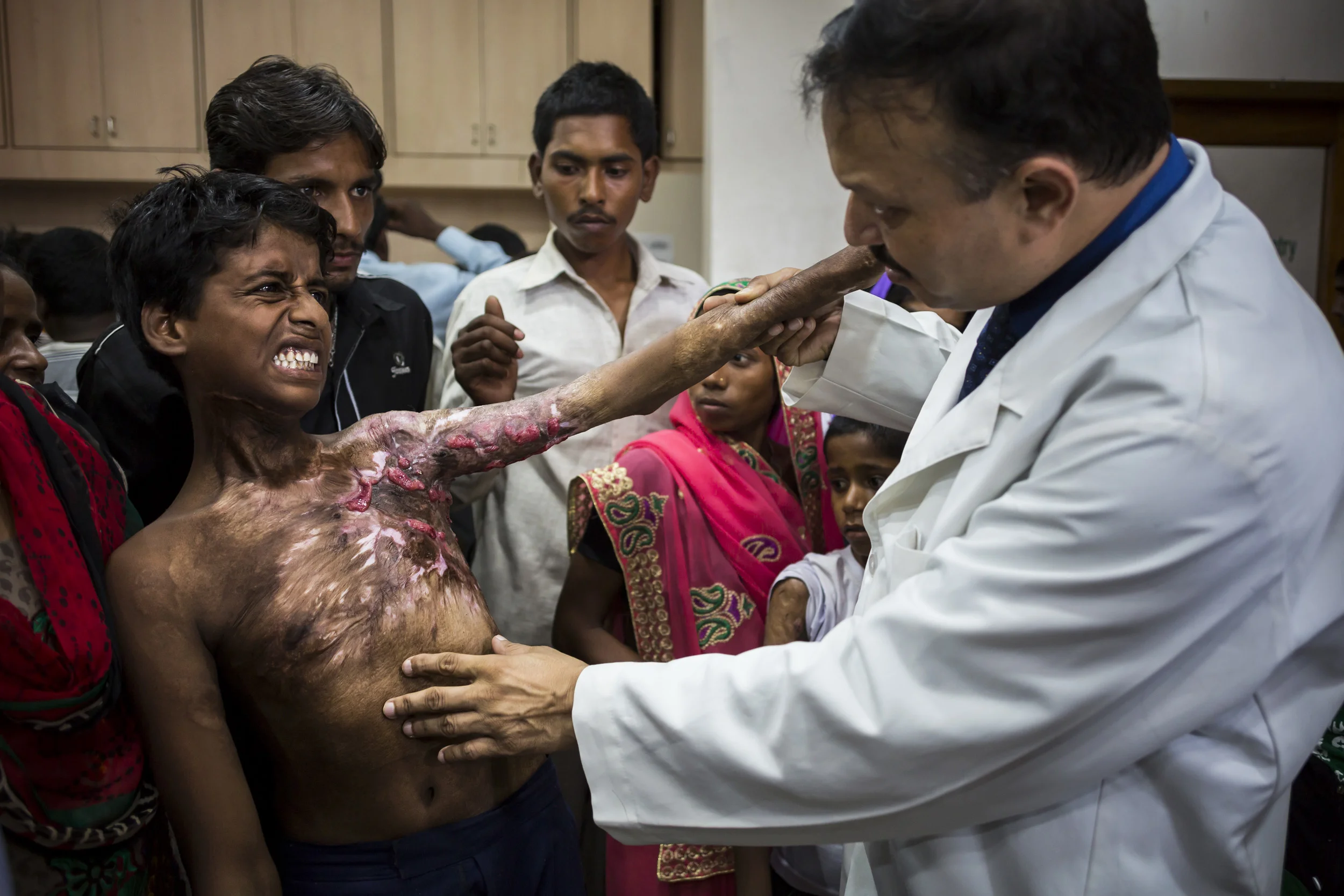 VARANASI, INDIA, 5 SEPTEMBER 2014: Renowned plastic surgeon to the poor, Dr Subodh Singh holds a burns camp for some of the over 6 million people burnt in India every year. Most victims are deeply impoverished and like millions of India's poor are u