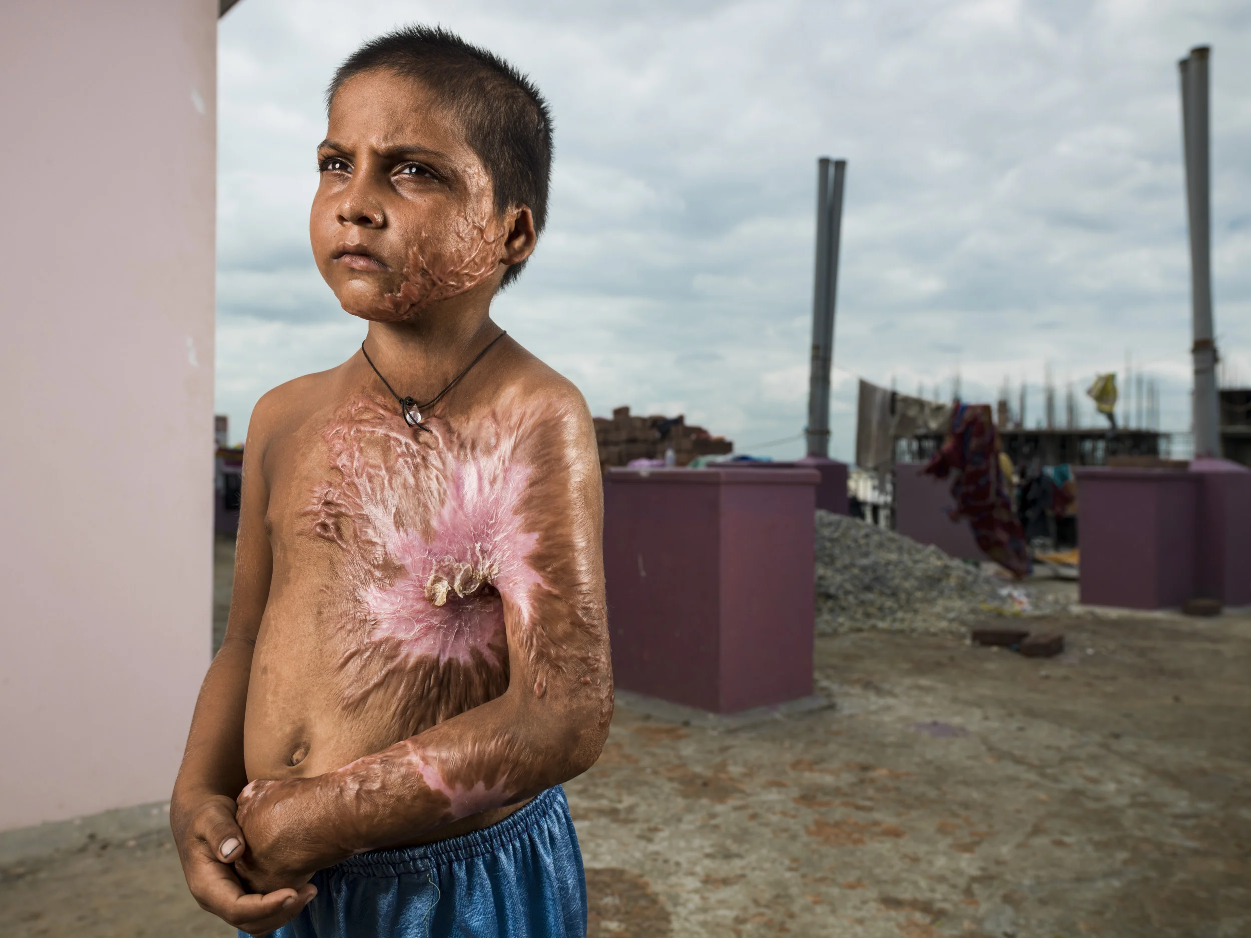 VARANASI, INDIA, 5 SEPTEMBER 2014: Burn victims seen at one of the very few burns camp offering free plastic surgery to the poor, a tiny fraction of the estimated 6 million people burnt in India every year. Most victims are deeply impoverished and l