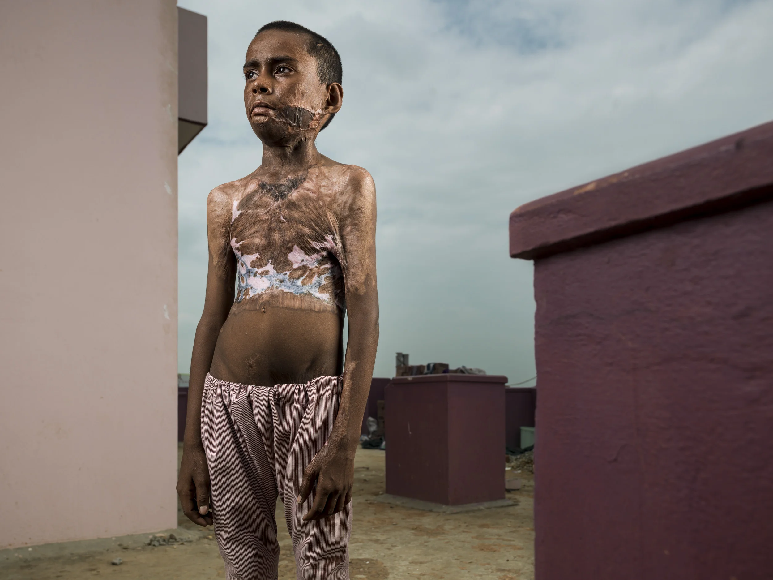 VARANASI, INDIA, 5 SEPTEMBER 2014: Burn victims seen at one of the very few burns camp offering free plastic surgery to the poor, a tiny fraction of the estimated 6 million people burnt in India every year. Most victims are deeply impoverished and l