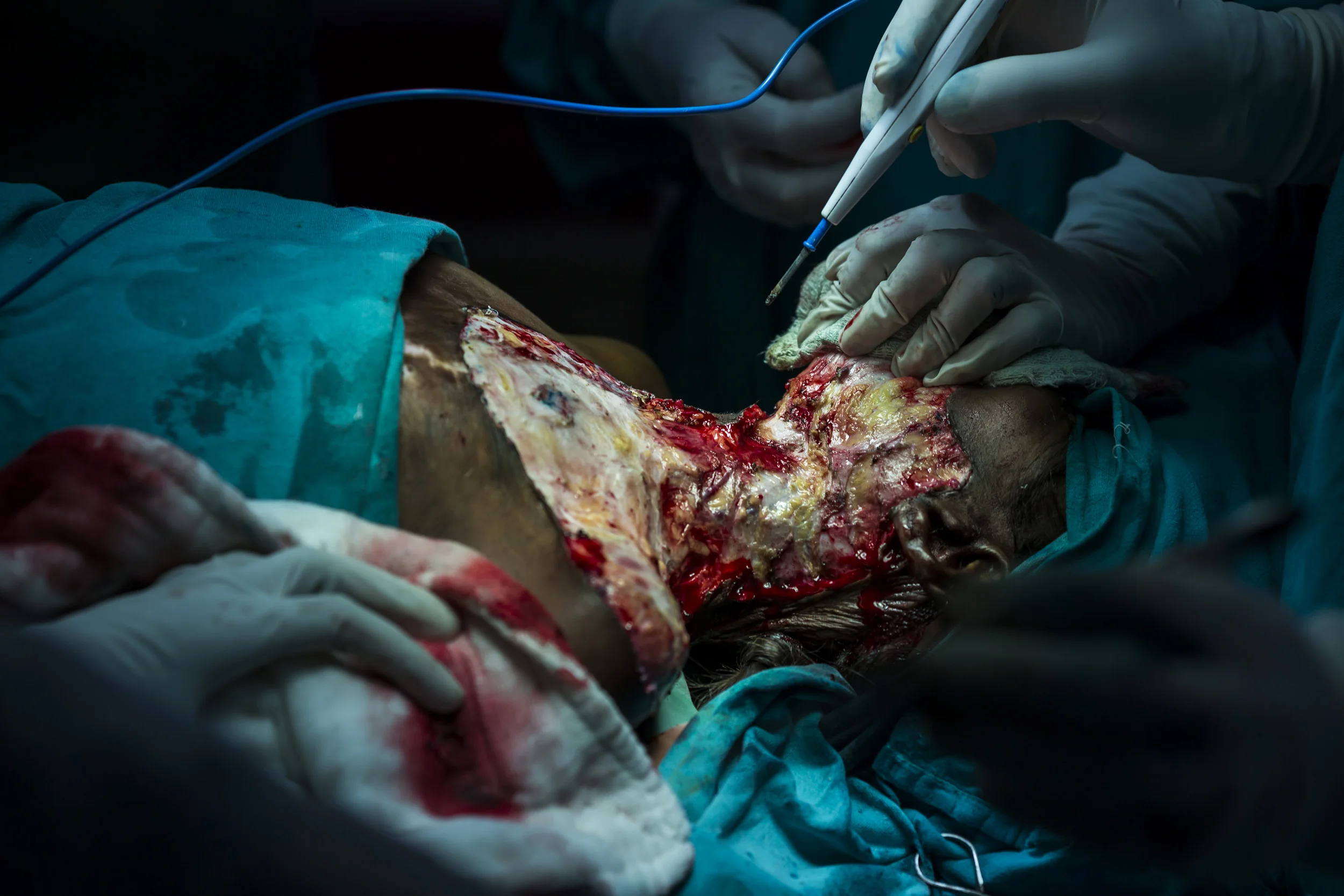 VARANASI, INDIA, 8 SEPTEMBER 2014: Renowned plastic surgeon to the poor, Dr Subodh Singh operates on burn victim Ragini Kumari, 10, who was badly burnt by a Kerosene fire when she was 2 years old, she is one of over 6 million people burnt in India e