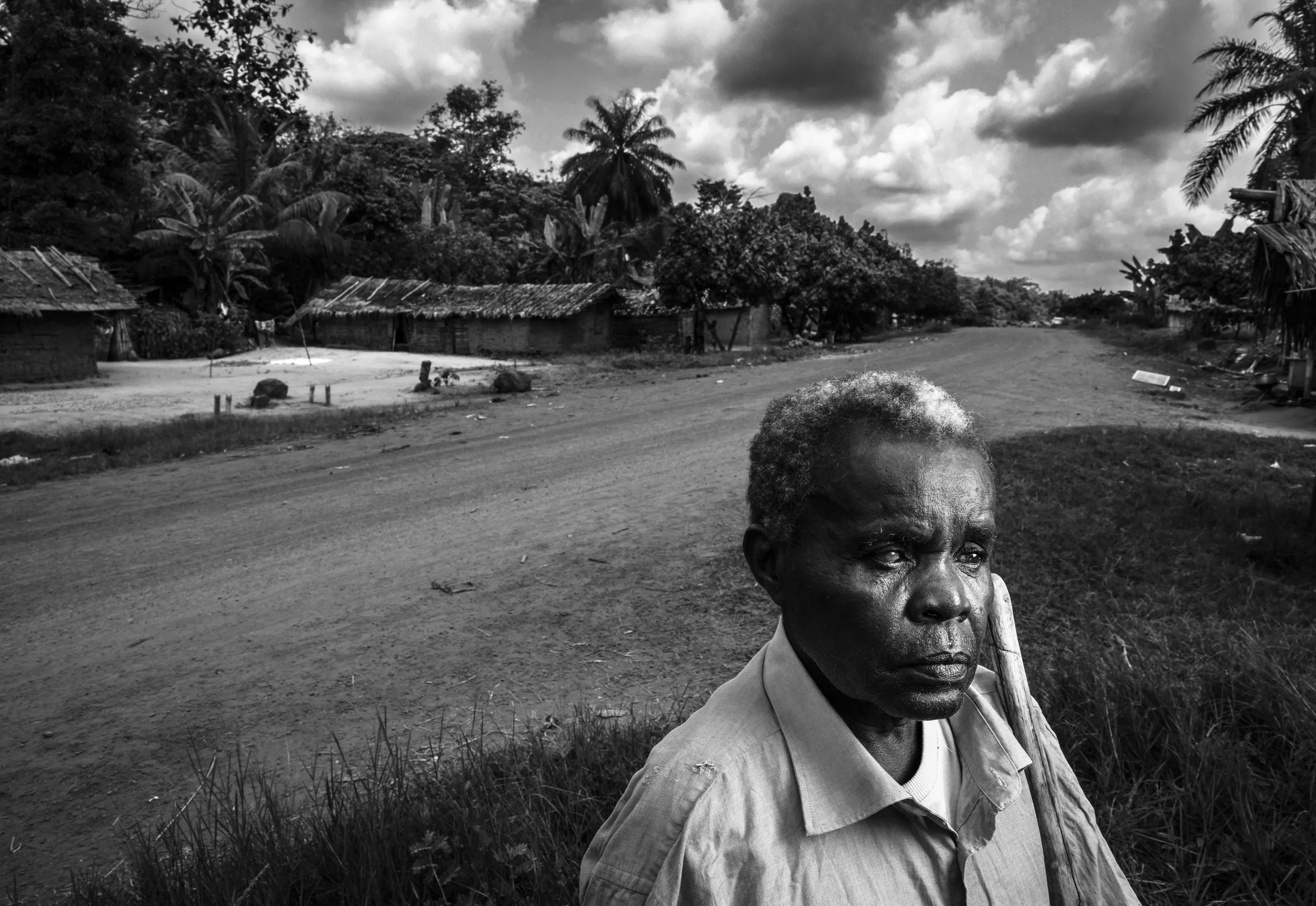 SALABONGO VILLAGE, WANIE RUKULA DISTRICT, DEMOCRATIC REPUBLIC OF CONGO: Sumbu Ramazani suffers from riverblindness. He has lost the ability to work as a farmer and two of his wives left him as he was unable to provide. He is now largely in the care
