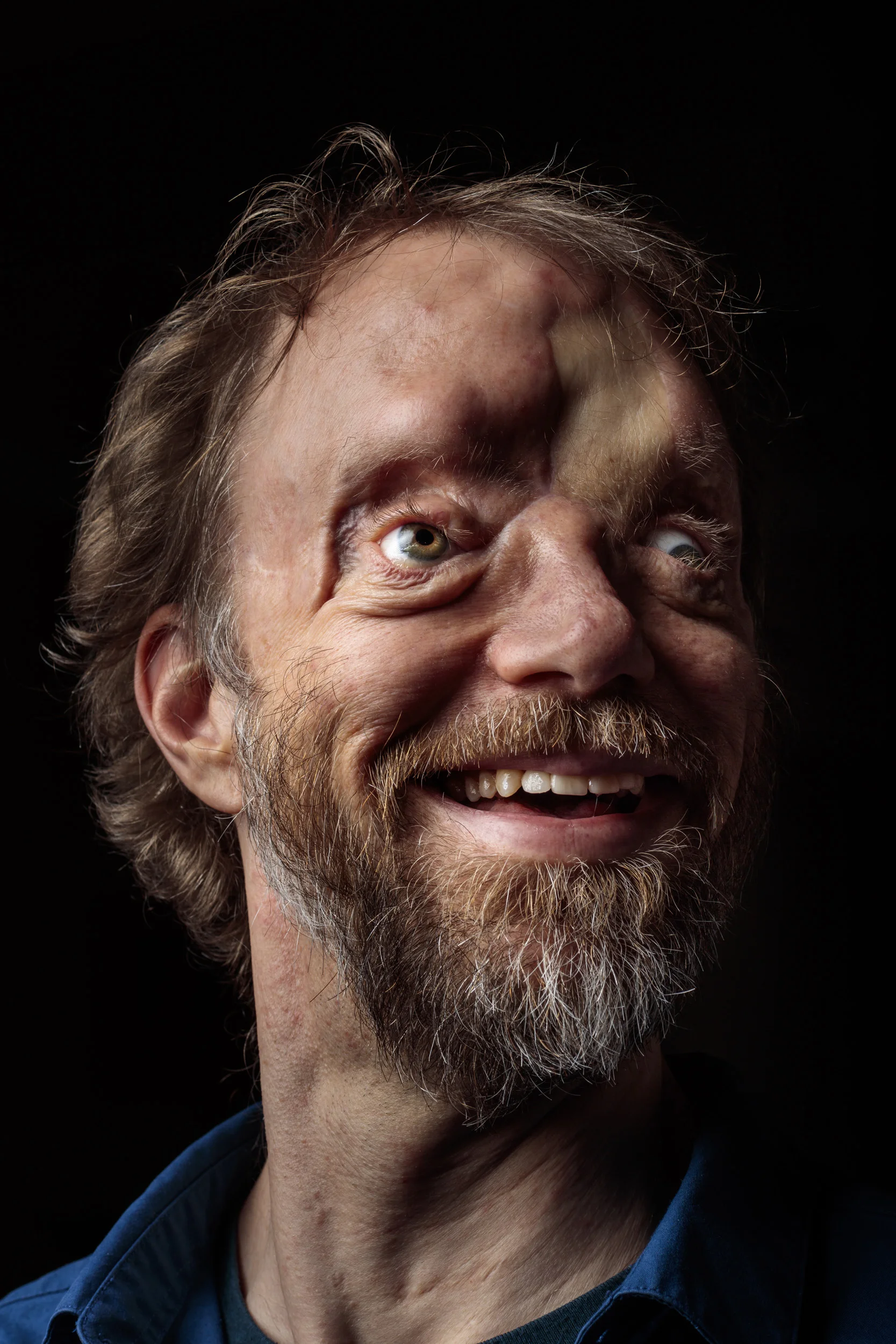 ANCHORAGE, ALASKA, 1 March 2016: When Dan Bigley was 25 he lost life as he knew when a bear mauled him, leaving his face ruined and his eyes blind after the incident. After relearning everything from how to match his socks to how to make a living, D