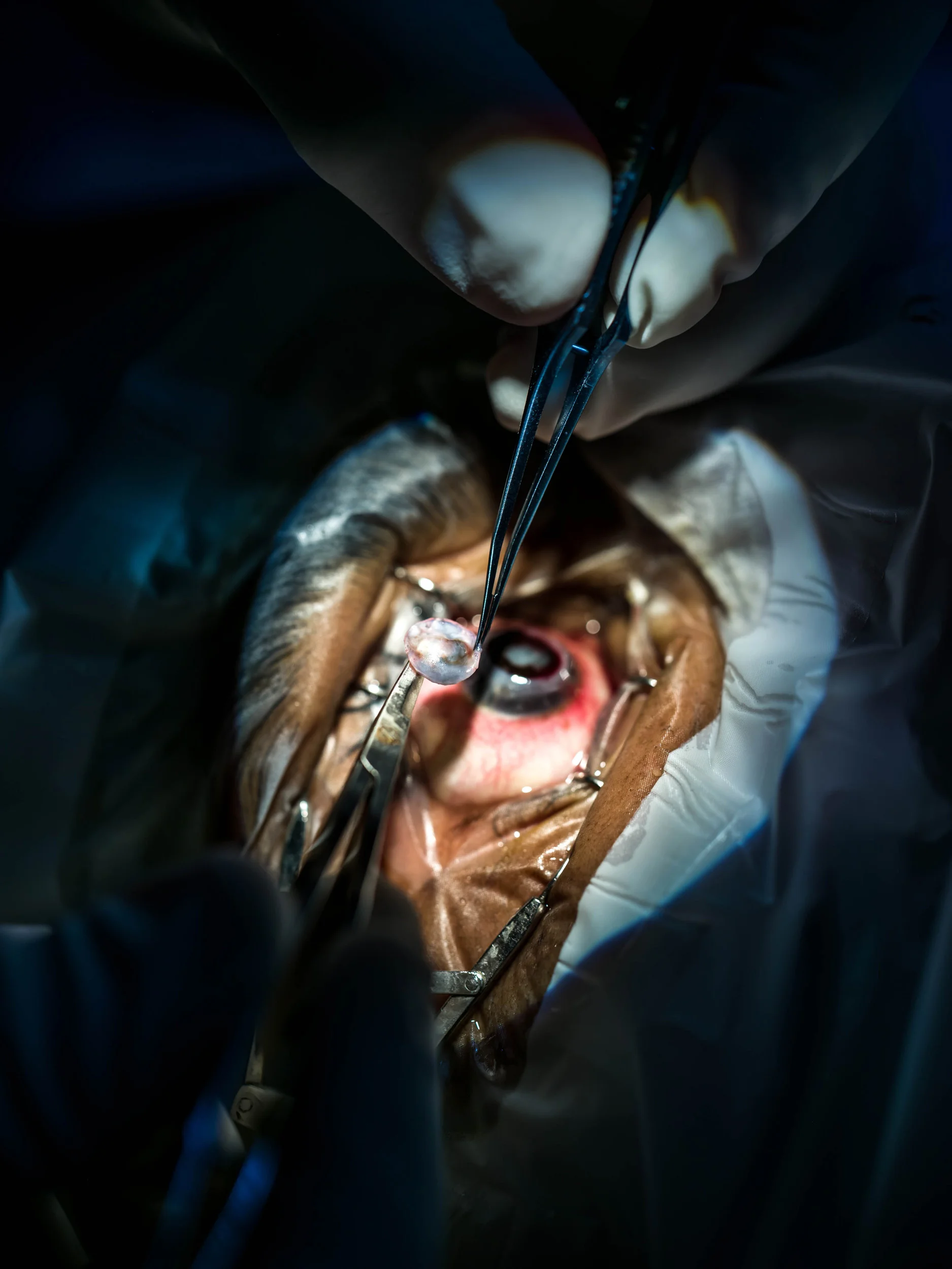 KOLKATA, INDIA, 13 JANUARY 2016: A Corneal graft is performed at the Vivekananda Mission Asram hospital on the outskirts of Kolkata. A cornea from a deceased donor is cut to precise measurements, the patients internal cataract is removed, a lens ins