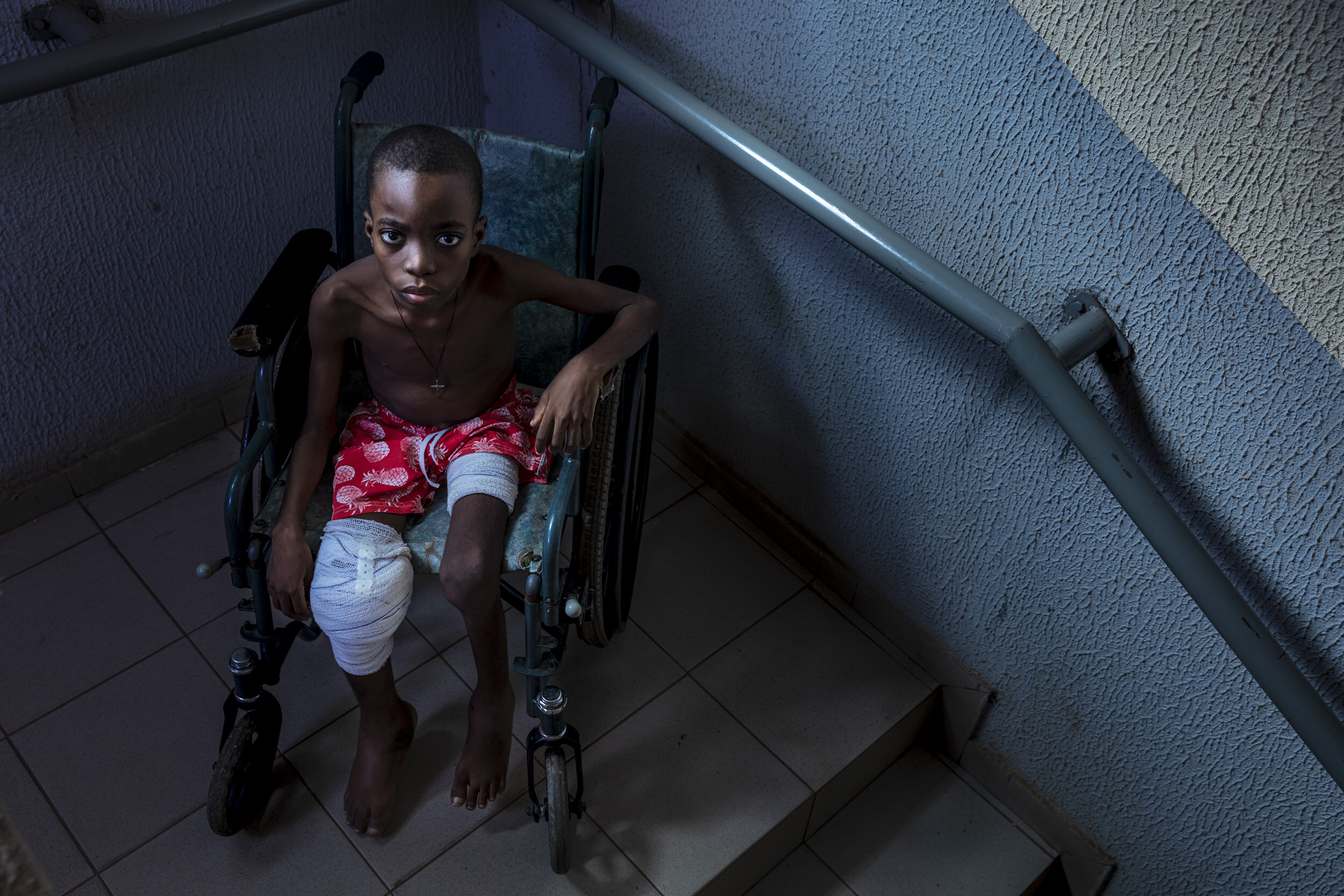 Ouidah, Benin: Joie Nontcho, 9, has been in hospital for the last two years due to debilitating and chronic Buruli ulcers which have been very difficult to get rid of. His sister dropped out of school and is with him to ensure he is cared for. Burul