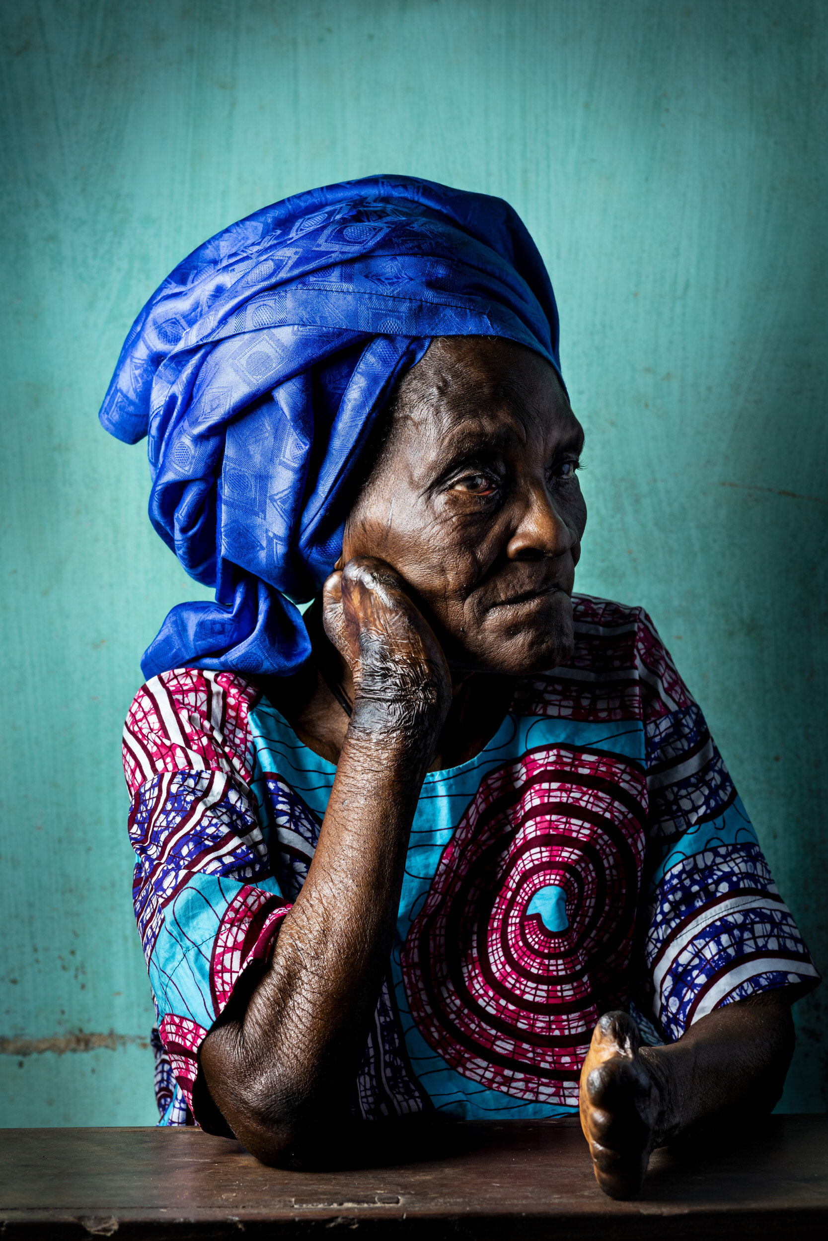 MADJRE, DOGBO, BENIN, OCTOBER 22, 2019: Veronica Gbado, 85, has had leprosy since the ago of 20. As a young woman, she lived in an area without access to western medicine and traditional healers wasted her time and money, resulting in a permanent co