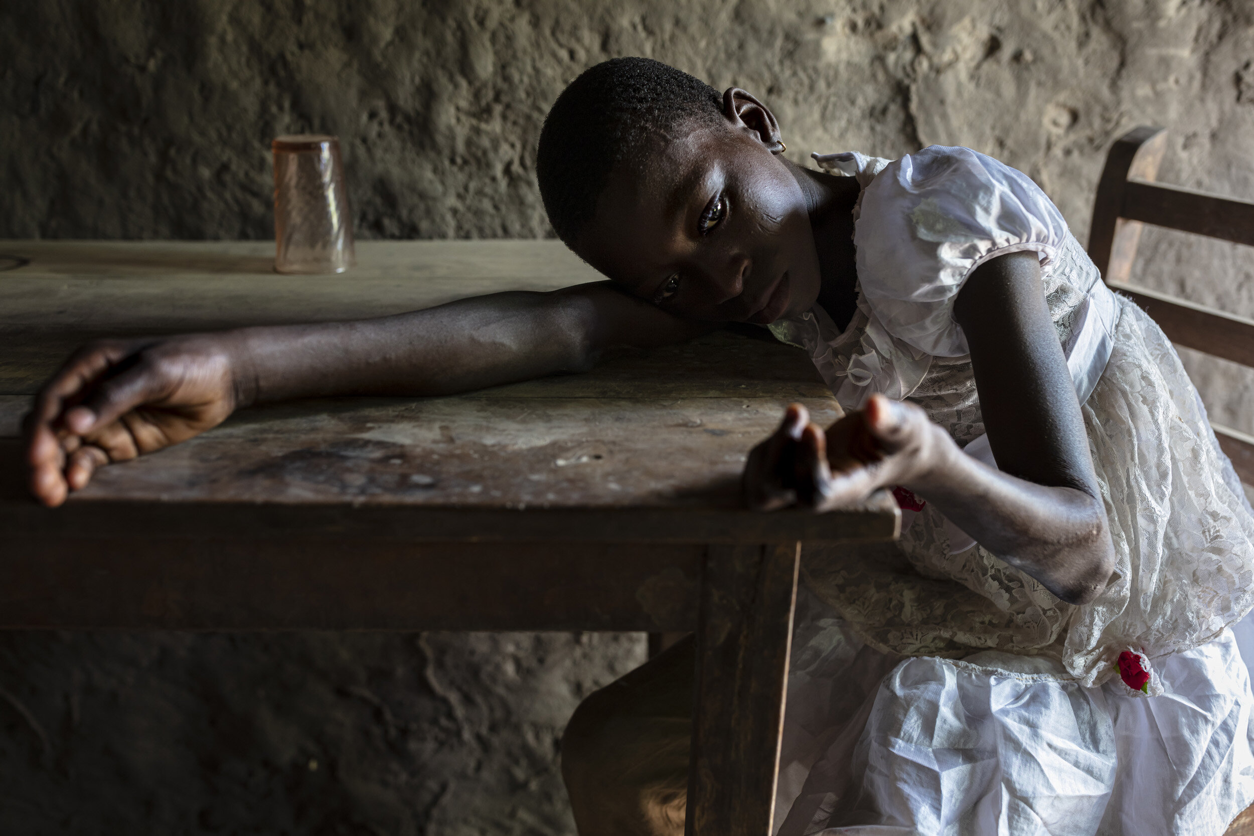 Dogbo, Benin: Ouinsson Hounssi, 12, is a recent survivor of Leprosy. She contracted the disease from her mother, who did not know she had the disease.. They were both treated at the same time, on an anti-biotic regime for a year. The bacteria that