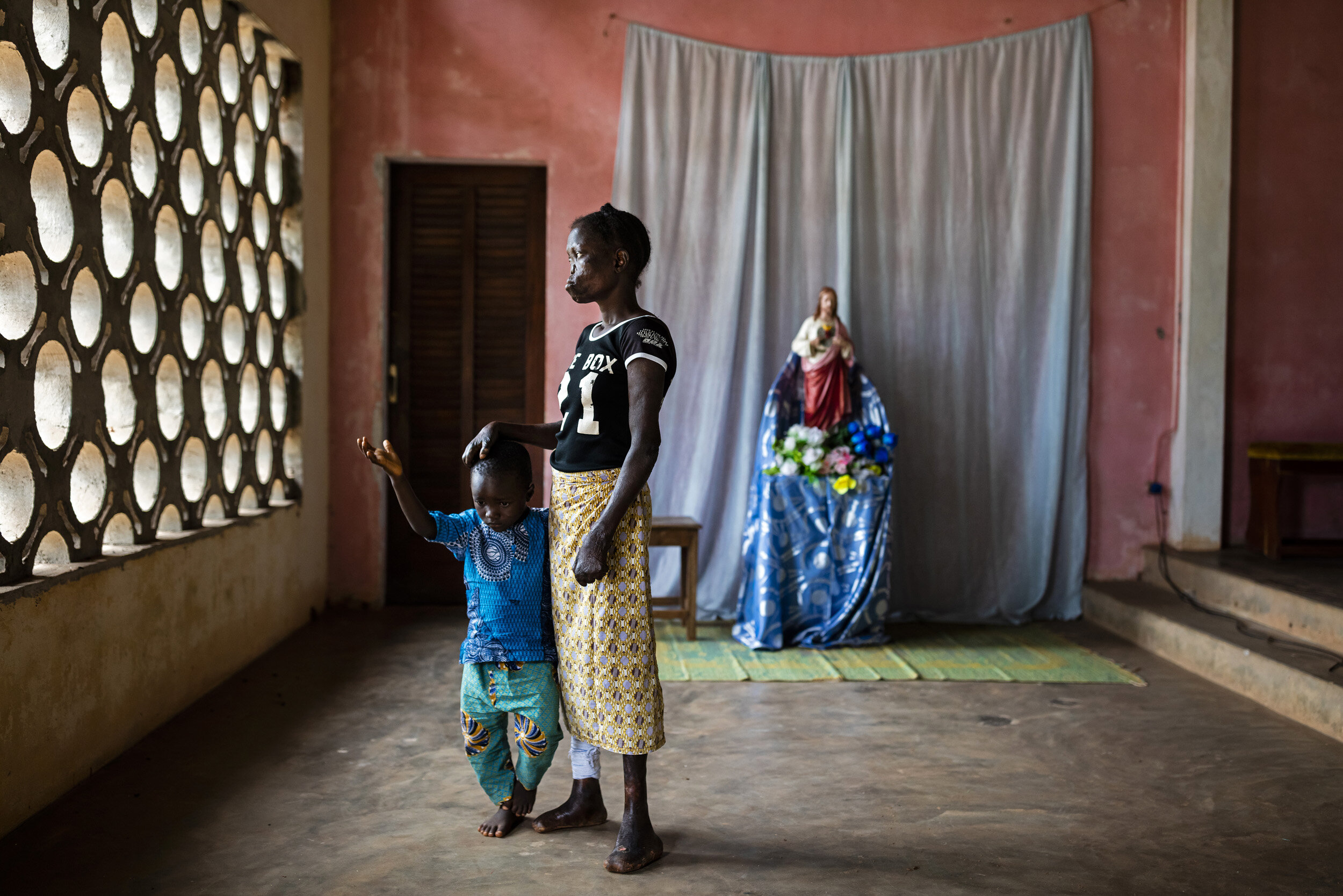 OUIDAH, BENIN, 25 OCTOBER 2019: Assiba Atonhou is only 24 years old. She has a four year-old son named Jeremy. Assiba contracted leprosy when she was 12 years old and it has ravaged her young body. She first discovered a wound on her arm that she sa