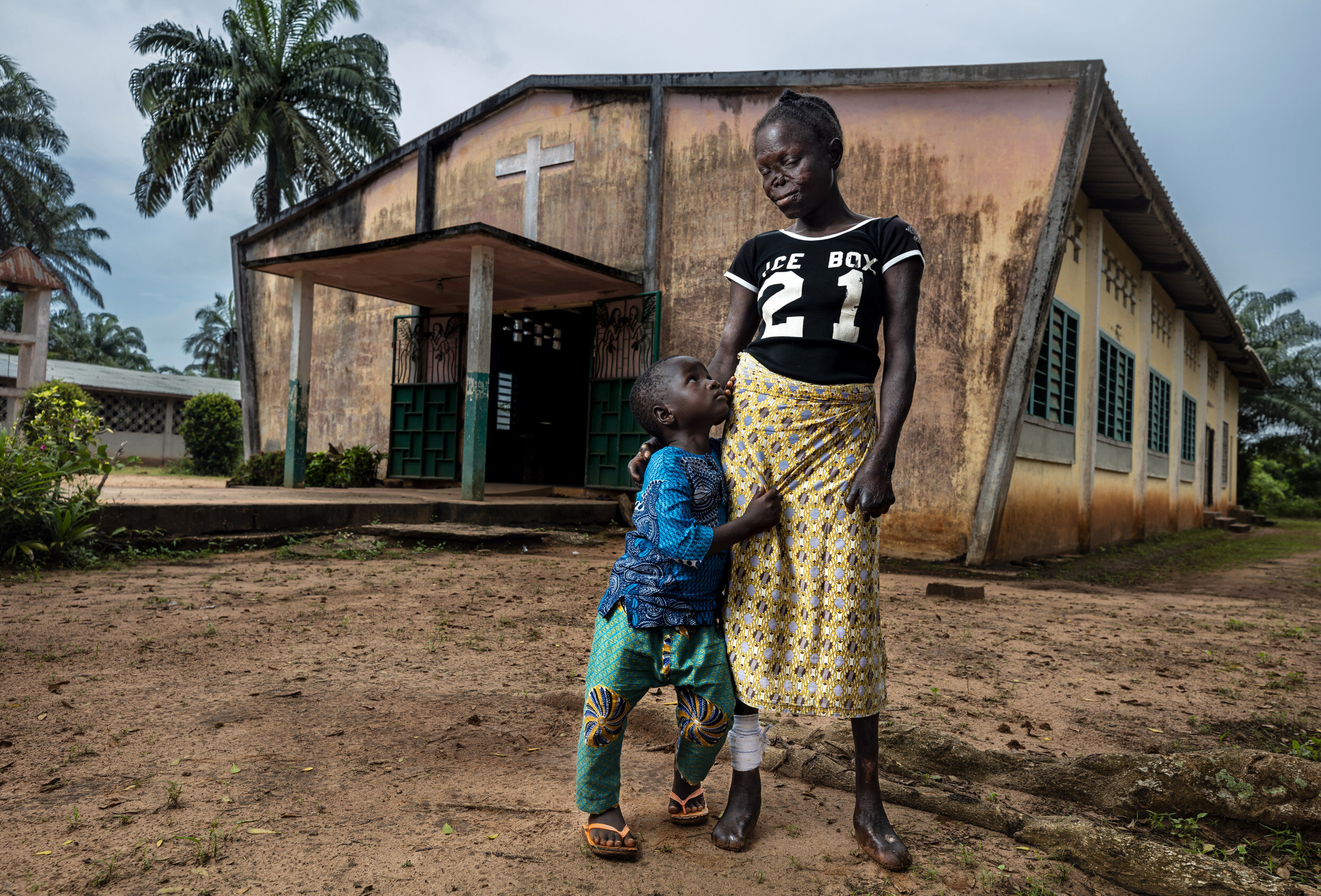 OUIDAH, BENIN, 25 OCTOBER 2019: Assiba Atonhou is only 24 years old. She has a four year-old son named Jeremy. Assiba contracted leprosy when she was 12 years old and it has ravaged her young body. She first discovered a wound on her arm that she sa