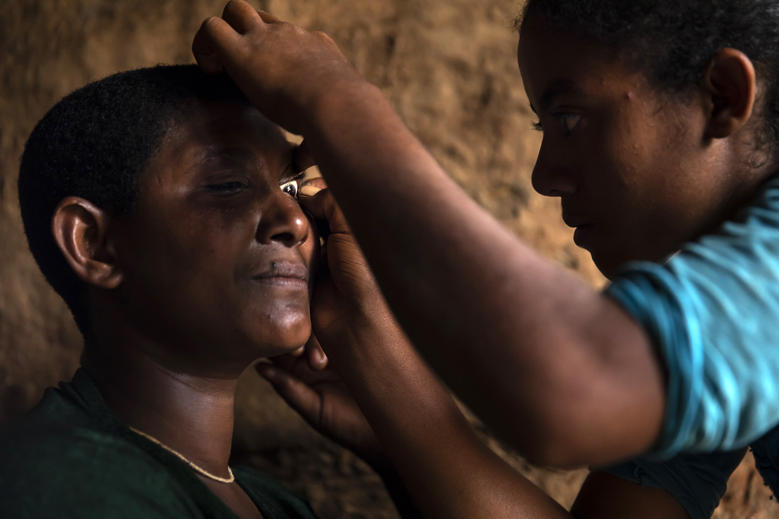 Gedefaye Metikie has had minor trichiasis (TT) for 3 or 4 years but has put off her surgery until her youngestchild is weaned. In the meantime, her oldest daughter Yalemworke Gashaw lovingly epilates the eyelashesrubbing against her mother’s eye bet