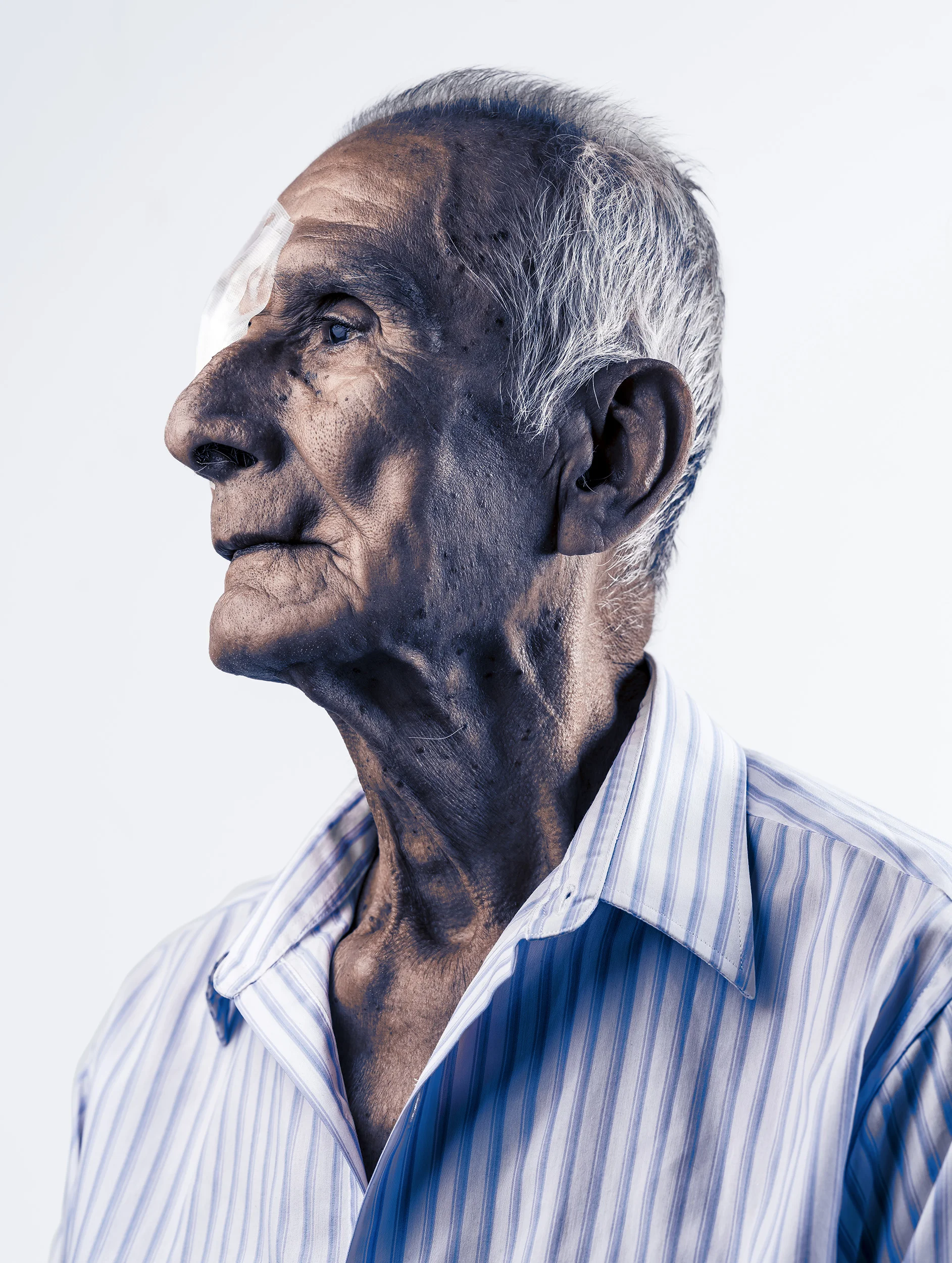 TARAPOTO, PERU, AUGUST 2017: Portraits of patients at a SEE International Eye camp in the Peruvian town of Tarapoto. SEE offers free eye surgery to poor communitie around the world who cannot afford or access eye care any other way. SEE relies on do