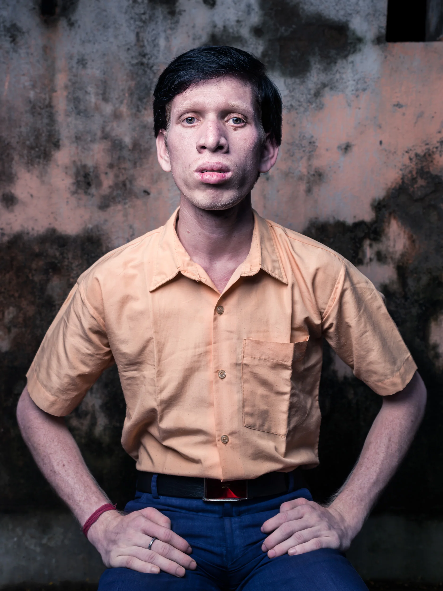 Blind Albino Boys - Vivekananda Mission School for the Blind - India, West Bengal, September 19, 2014.