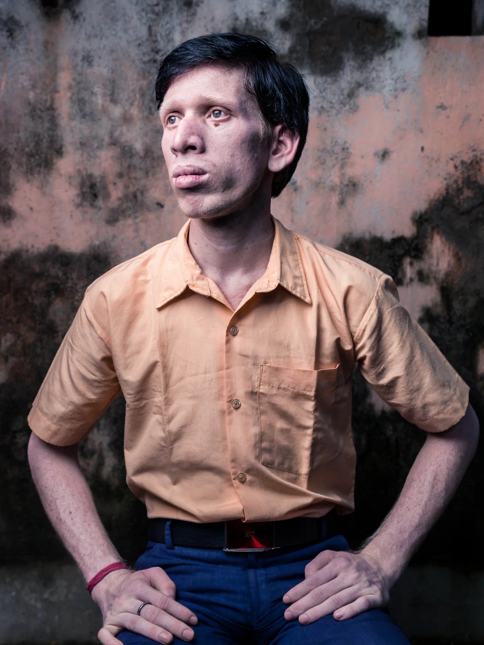 Blind Albino Boys - Vivekananda Mission School for the Blind - India, West Bengal, September 19, 2014.