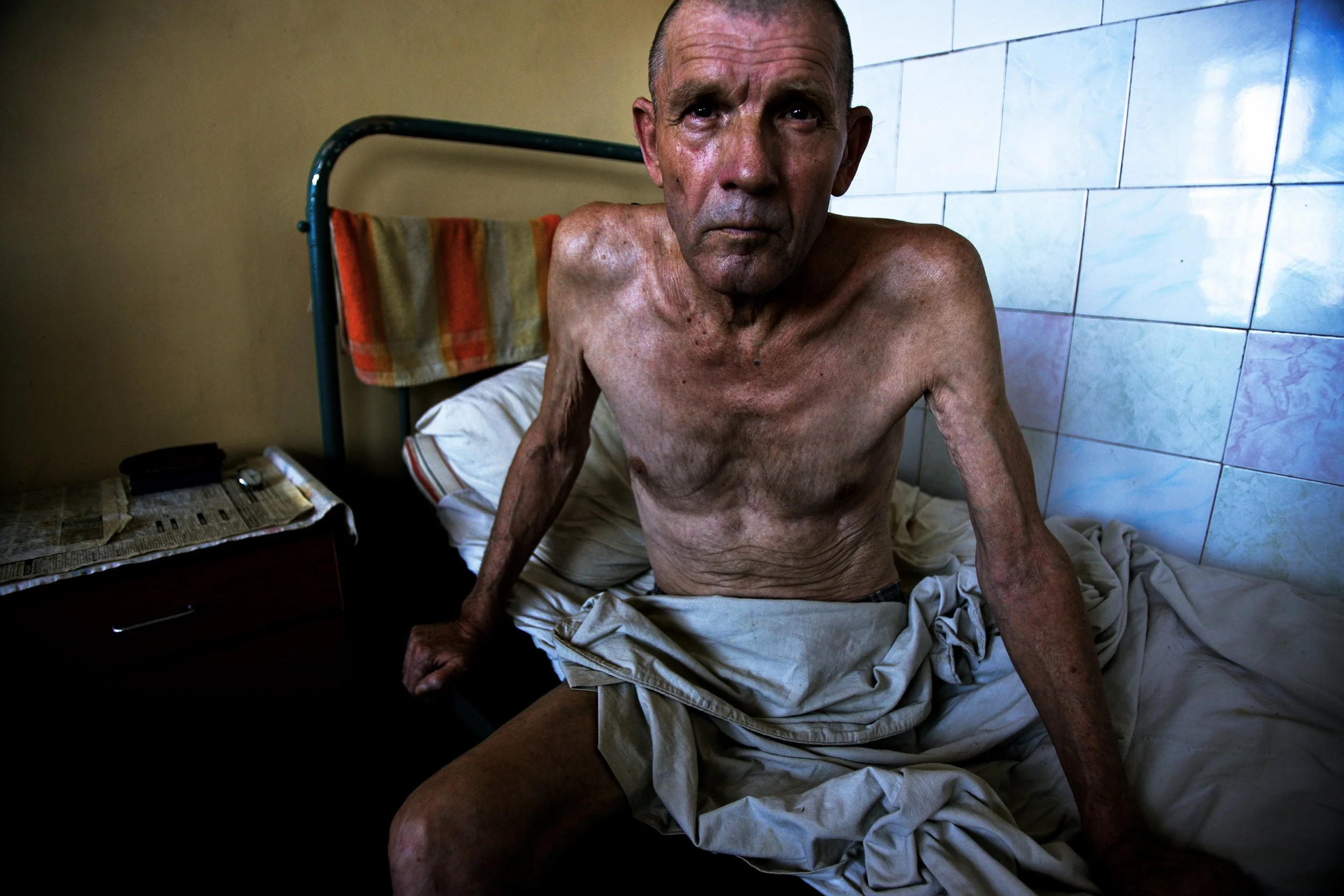 KHERSON, UKRAINE - AUGUST 18 2005: A prisoner with full blown Aids lies in an intensive care ward at Kherson Prison Hospital for prisoners with HIV/Aids. Kherson Prison is the only Prison in Ukraine where HIV + prisoners are treated. There are no pro
