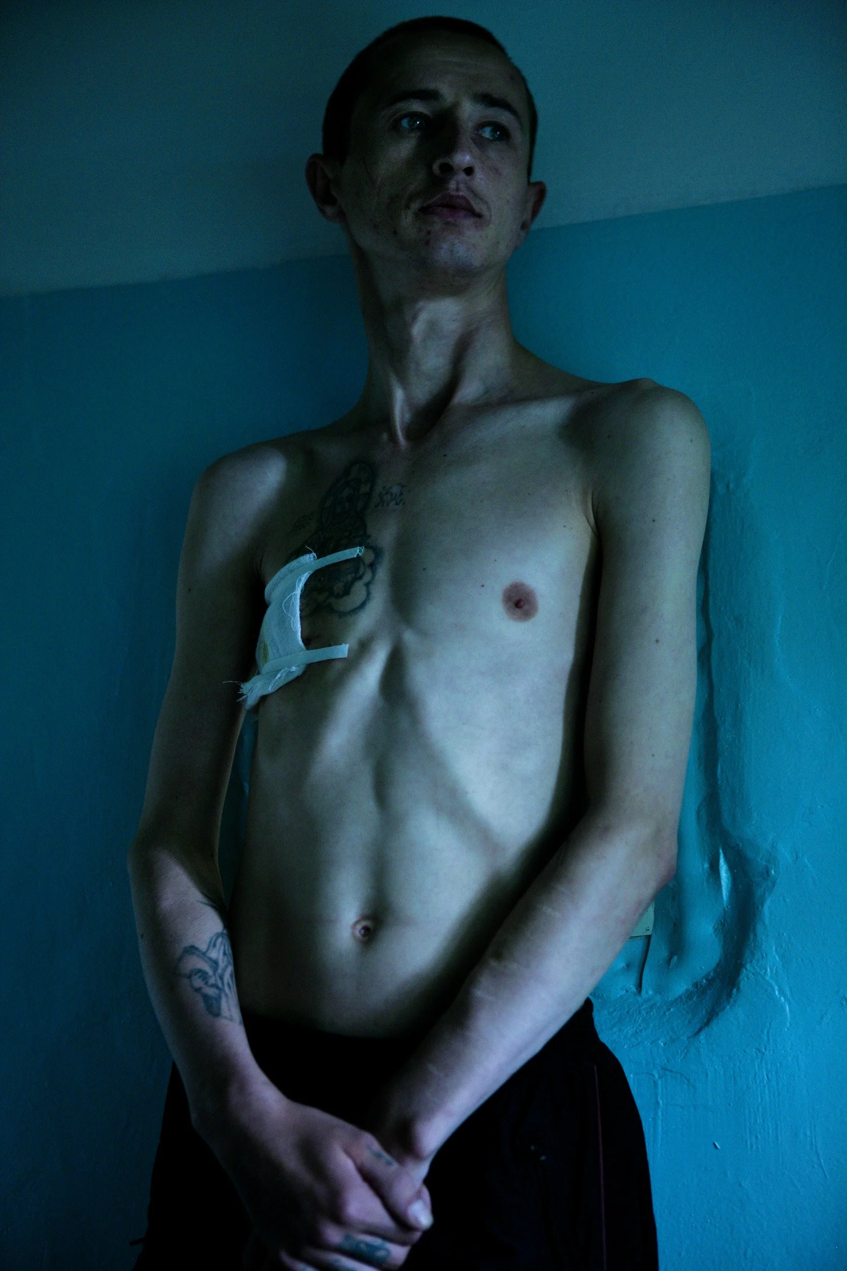 POLTAVA, UKRAINE - AUGUST 15 2005: Andrey, 28, waits to be X-rayed at the local TB hospital. He is HIV+ and has advanced TB. They are often linked in Ukraine. Andrey received a five year prison sentence for drug possesion but his parents were able t