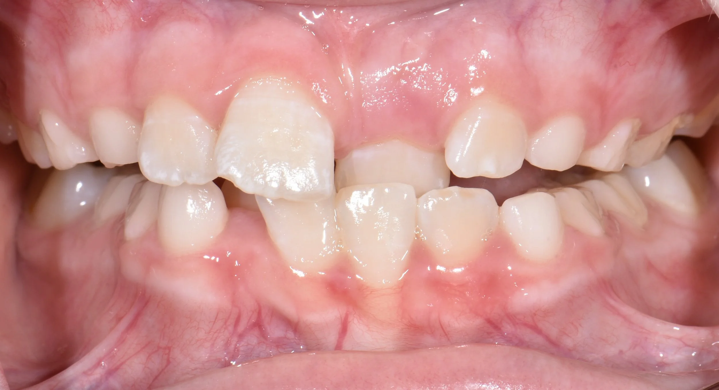 Close-up of a child's mouth showing mixed primary and permanent teeth with some misalignment and spacing.