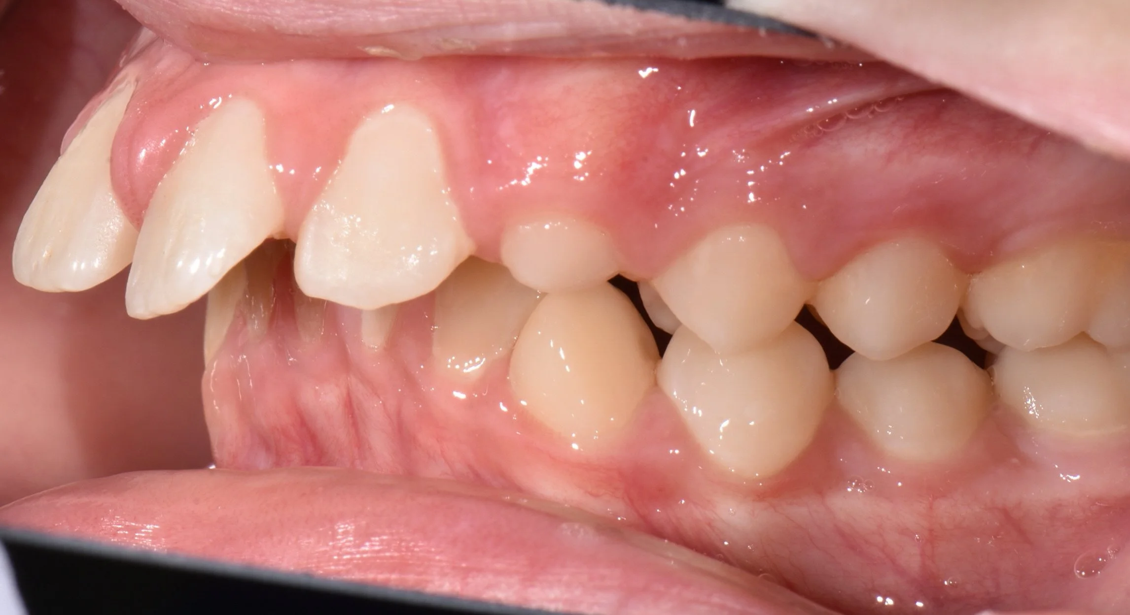 Close-up of a child's mouth showing crooked and misaligned teeth with gum tissues.