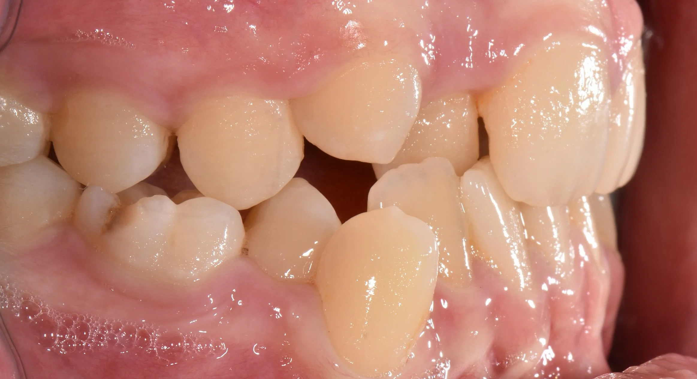 Close-up of a person's upper and lower teeth, showing signs of dental crowding and misalignment.
