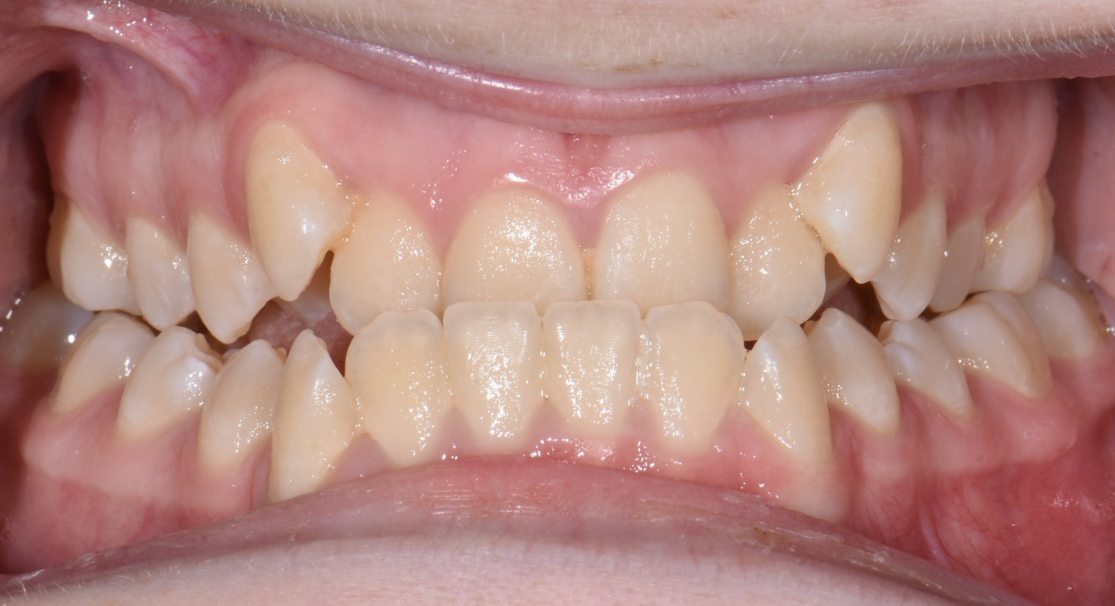 Close-up of a person's mouth showing uneven, crowded teeth with overlapping and misalignment.
