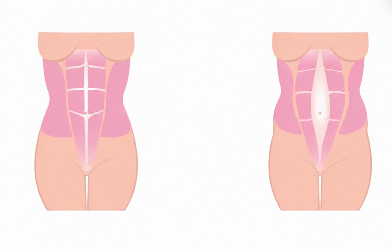 Why Modifying Your Ab Workout With Diastasis Recti Is Not The Answer