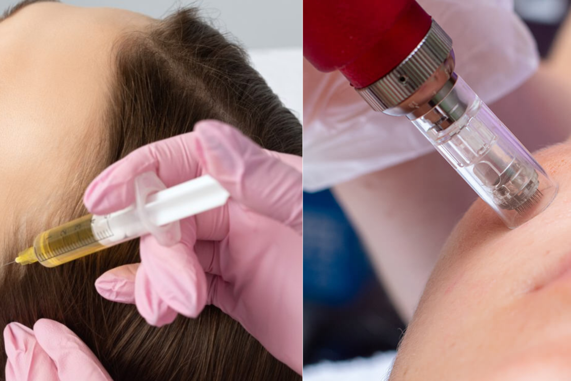 Side-by-side photos of cosmetic procedures; the left shows a person receiving a needle injection in their scalp, wearing pink gloves, and the right shows a person receiving an injection with a syringe in their face.