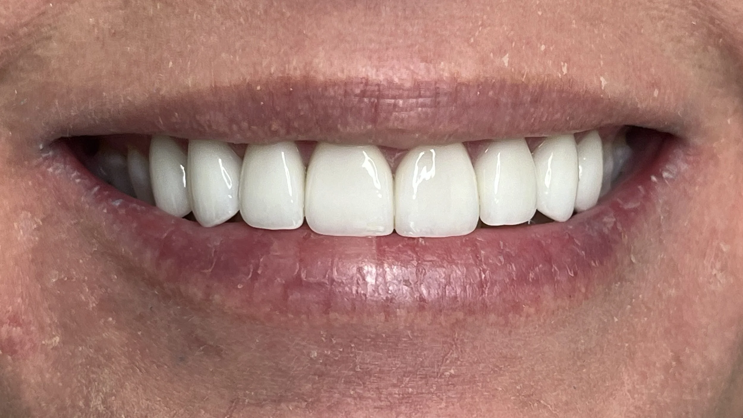 Vie-Lavelle-Smile-Design-After-Smile-IMG_1418.jpg