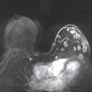 Noninvasive strategies for breast cancer early detection