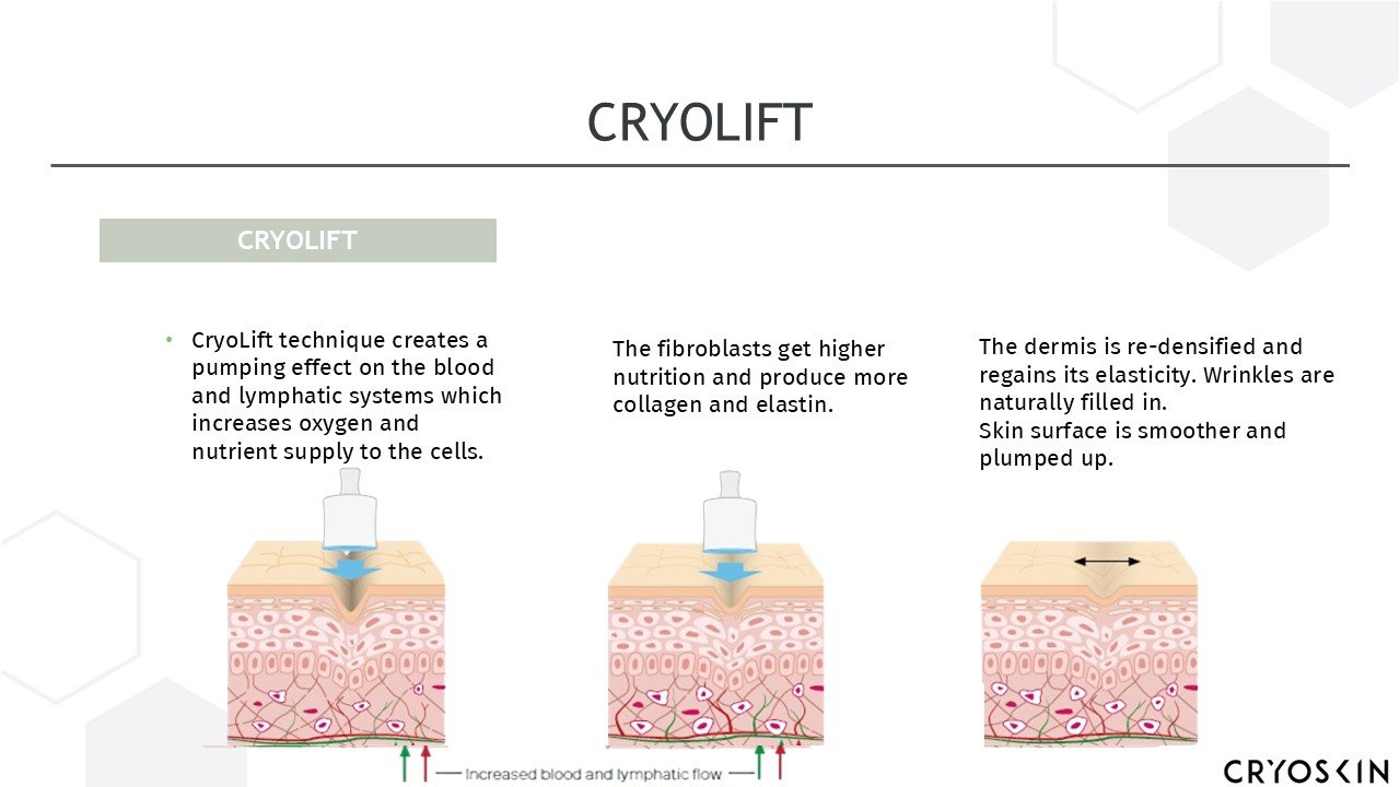 Infographic explaining CryoLift technique, showing three stages of skin treatment with a device, illustrating increased blood flow, collagen production, and skin smoothing.