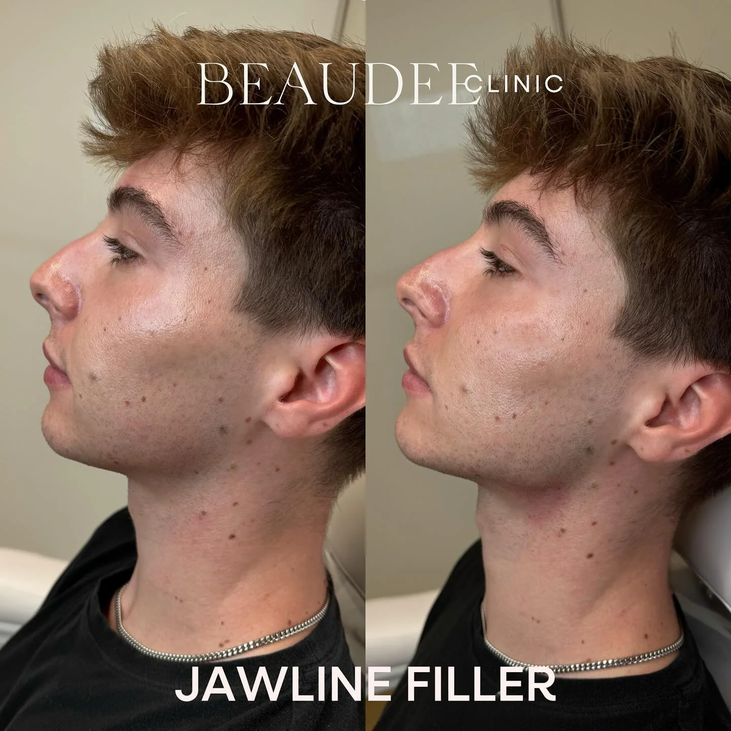 Jawline filler can provide more definition and structure without altering your natural features. In this case, we used just 1 syringe to enhance an already strong profile&mdash;showing how even a small amount can make a noticeable difference&thinsp;
