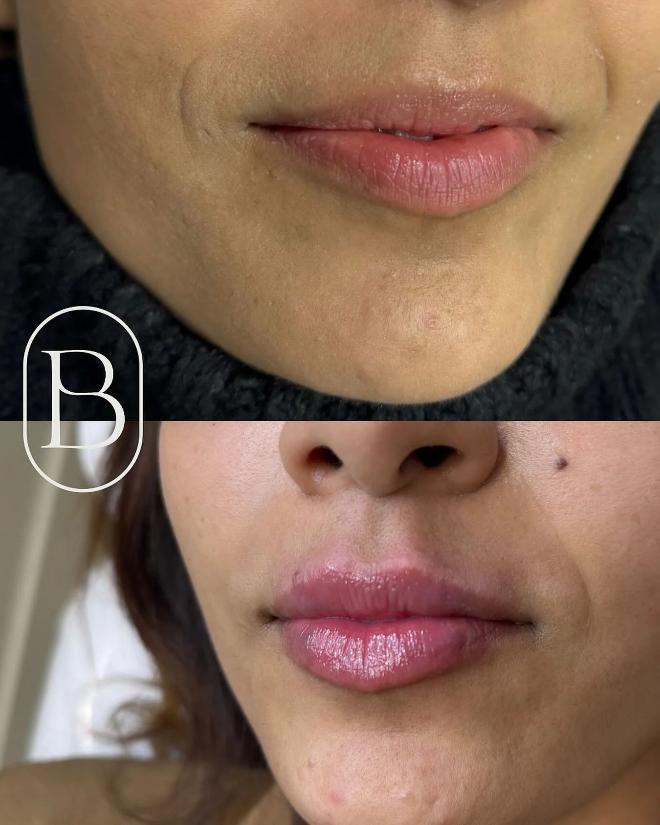 💋 Lips losing volume with age? Filler isn&rsquo;t just for bigger lips&mdash;it restores shape + natural plumpness. This beauty had 2 sessions with &frac12; syringe each for soft, youthful lips. ✨&thinsp;
&thinsp;&thinsp;
📍 Beaudee Clinic inside Th
