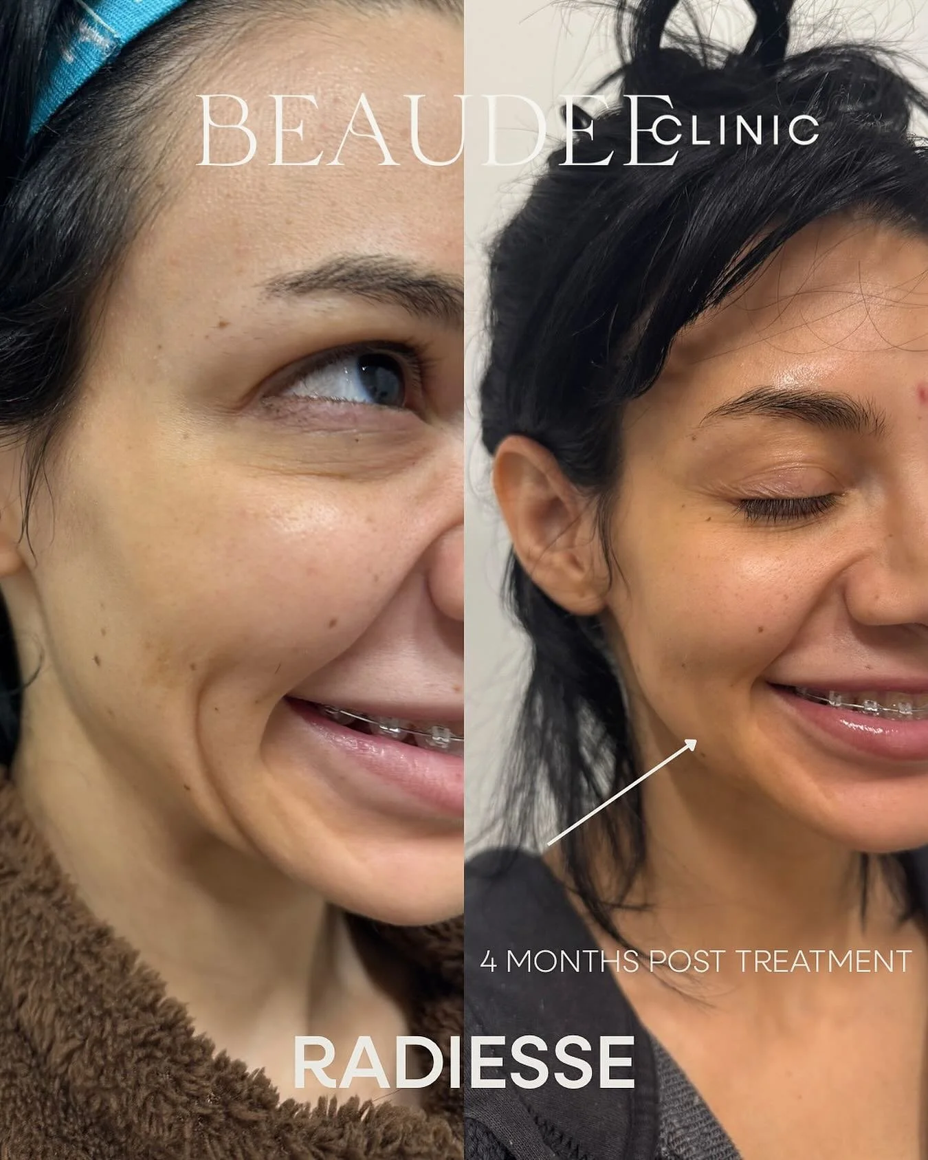 Are you noticing extra lines around your mouth when you smile? 👀&thinsp;
These are called accordion lines &mdash; they form as we lose volume in the cheeks and lower face.&thinsp;
&thinsp;
To treat this, we used Radiesse, a collagen-stimulating fill