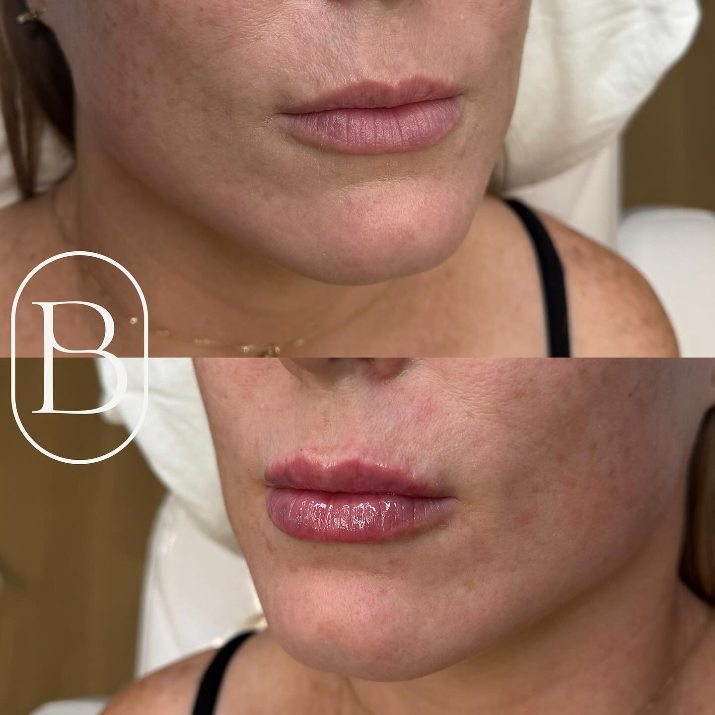 Just a half-syringe refresh for that perfect plump 💉✨&thinsp;
&thinsp;&thinsp;&thinsp;&thinsp;
📍 Beaudee Clinic inside The Suite House 20 Leslie Street, Unit 206, Suite 23&thinsp;&thinsp;&thinsp;&thinsp;&thinsp;&thinsp;&thinsp;&thinsp;&thinsp;&thin
