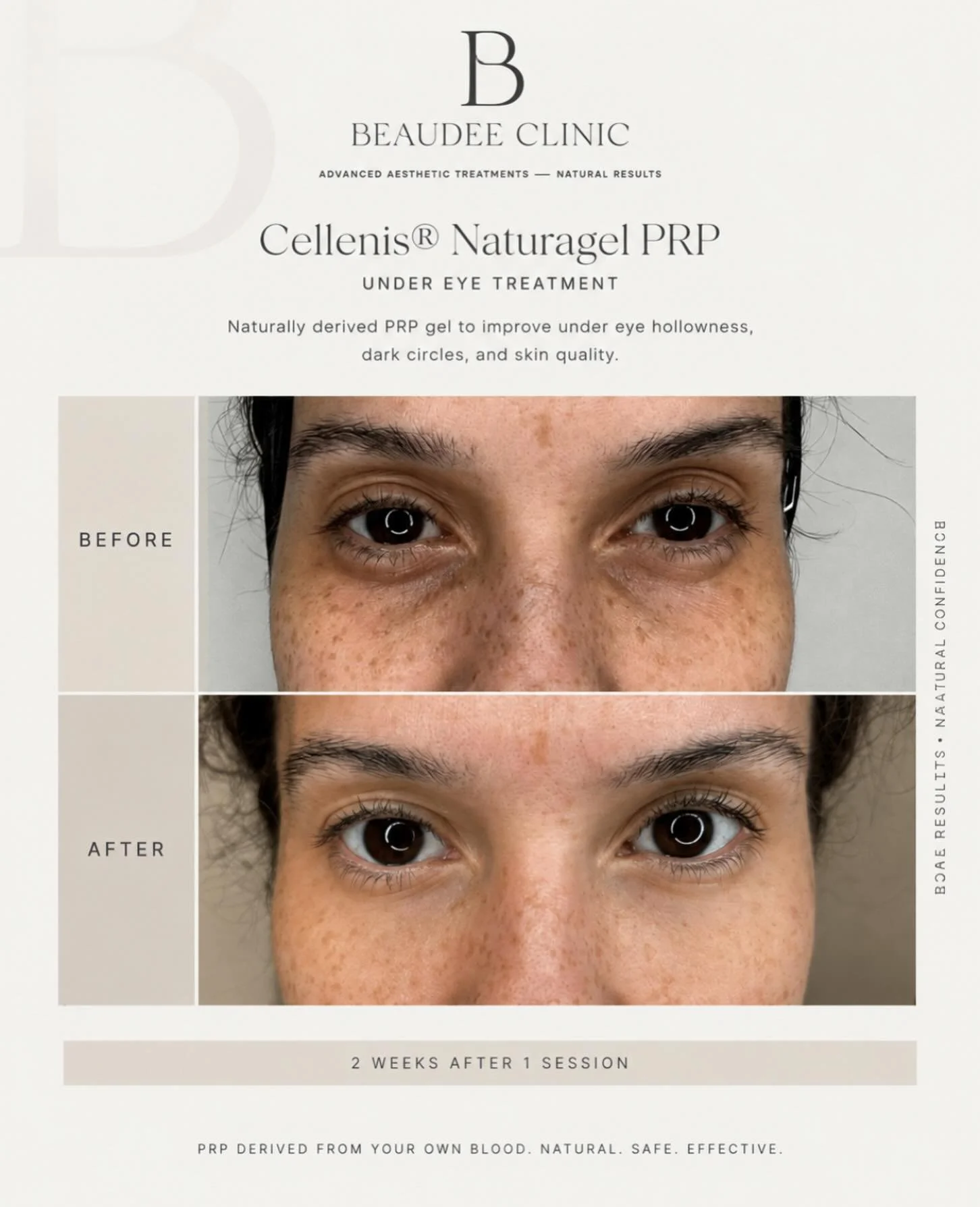 ✨ Cellenis&reg; NaturaGel PRP &mdash; regenerative volume, using your own blood.

NaturaGel transforms your own PRP into a natural gel that can be used to restore subtle volume while supporting overall skin quality &mdash; without traditional dermal 